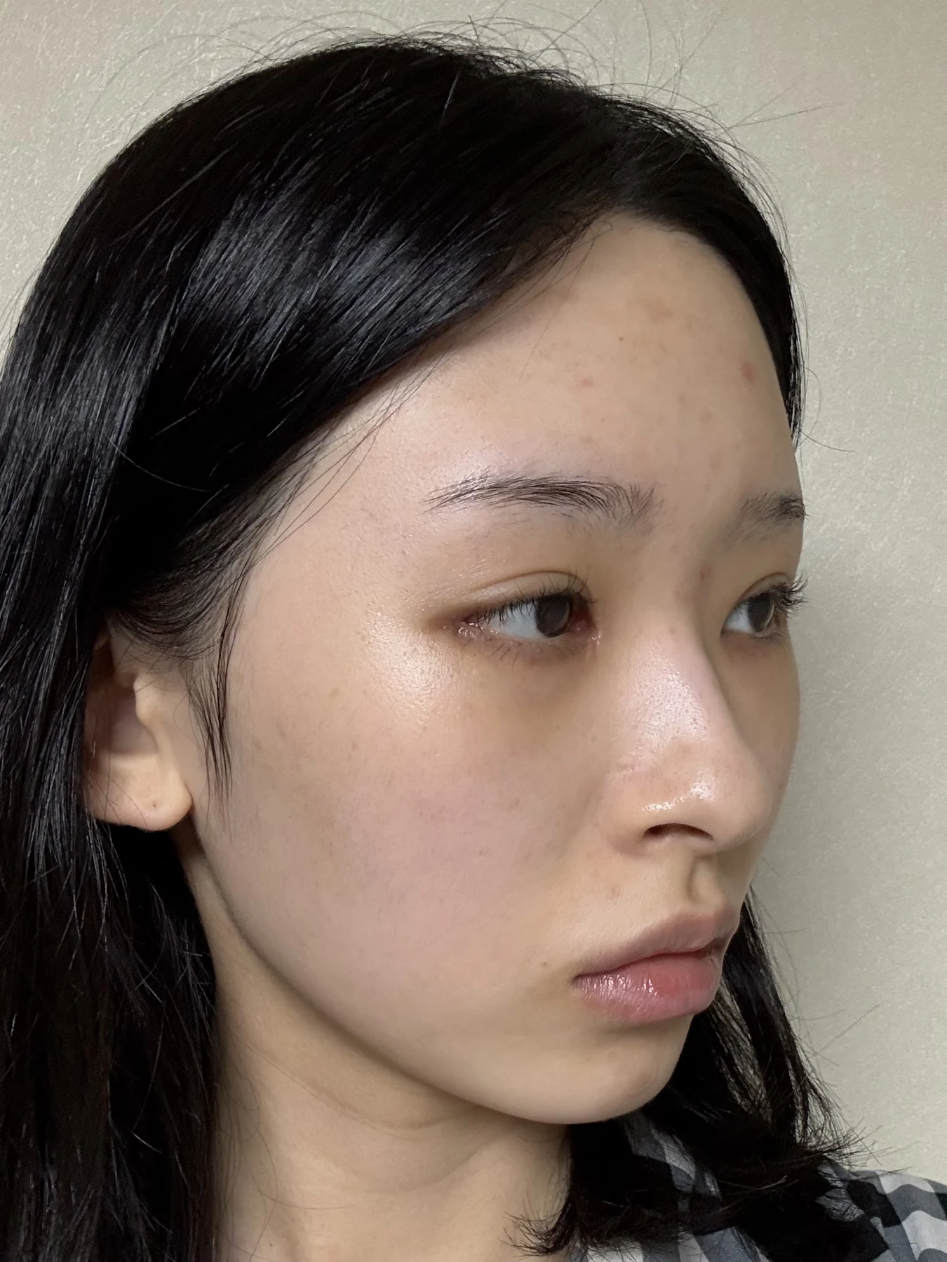 Eye-corner surgery: six-month recovery and smiling concerns · Case 089 at Answer Plastic Surgery. Opposite oblique view — 2 weeks after surgery, eye-corner surgery at Answer Plastic Surgery (case 089).