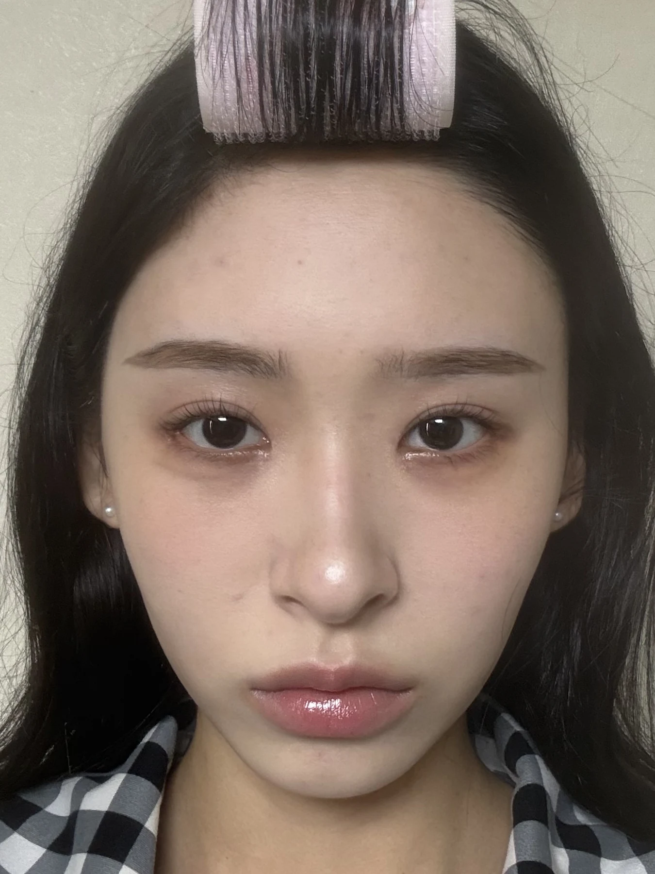 Eye-corner surgery: six-month recovery and smiling concerns · Case 089 at Answer Plastic Surgery. Front view — 1 month after surgery, eye-corner surgery at Answer Plastic Surgery (case 089).