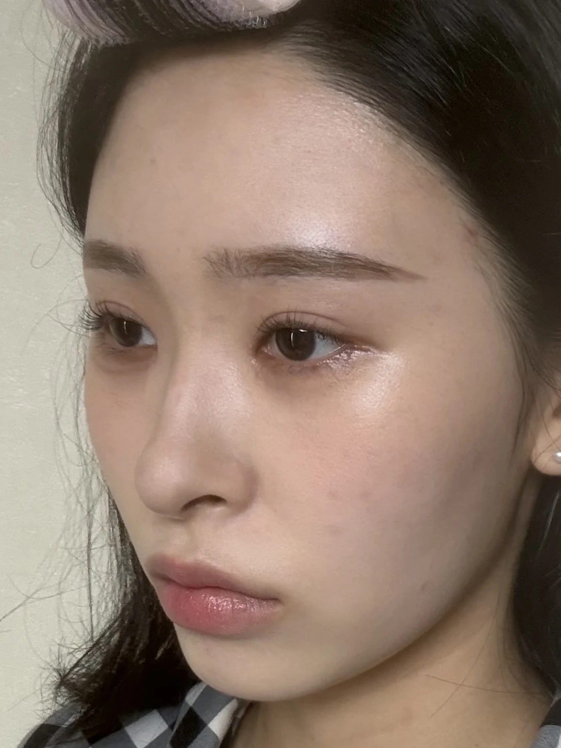 Eye-corner surgery: six-month recovery and smiling concerns · Case 089 at Answer Plastic Surgery. Oblique view — 1 month after surgery, eye-corner surgery at Answer Plastic Surgery (case 089).