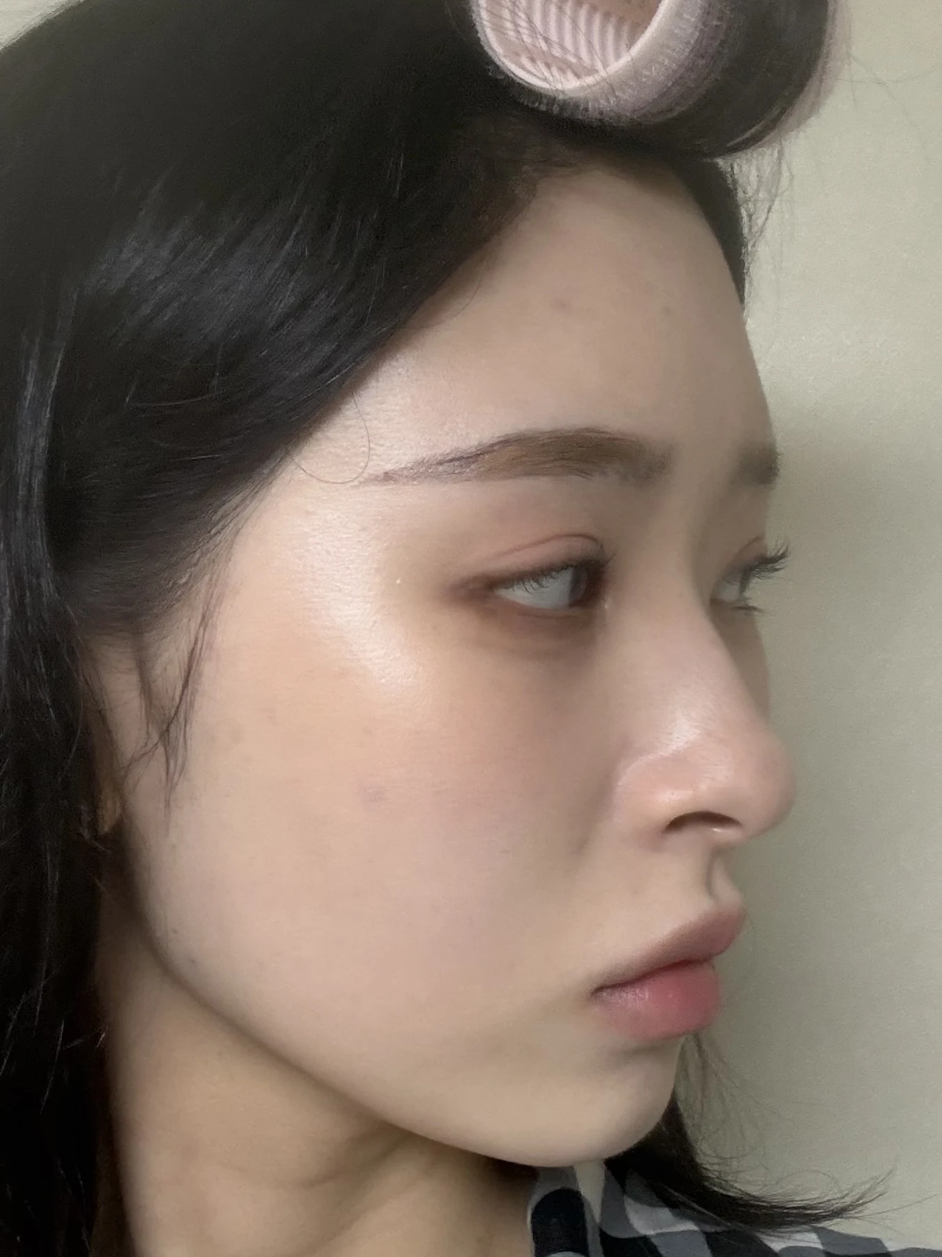 Eye-corner surgery: six-month recovery and smiling concerns · Case 089 at Answer Plastic Surgery. Opposite oblique view — 1 month after surgery, eye-corner surgery at Answer Plastic Surgery (case 089).