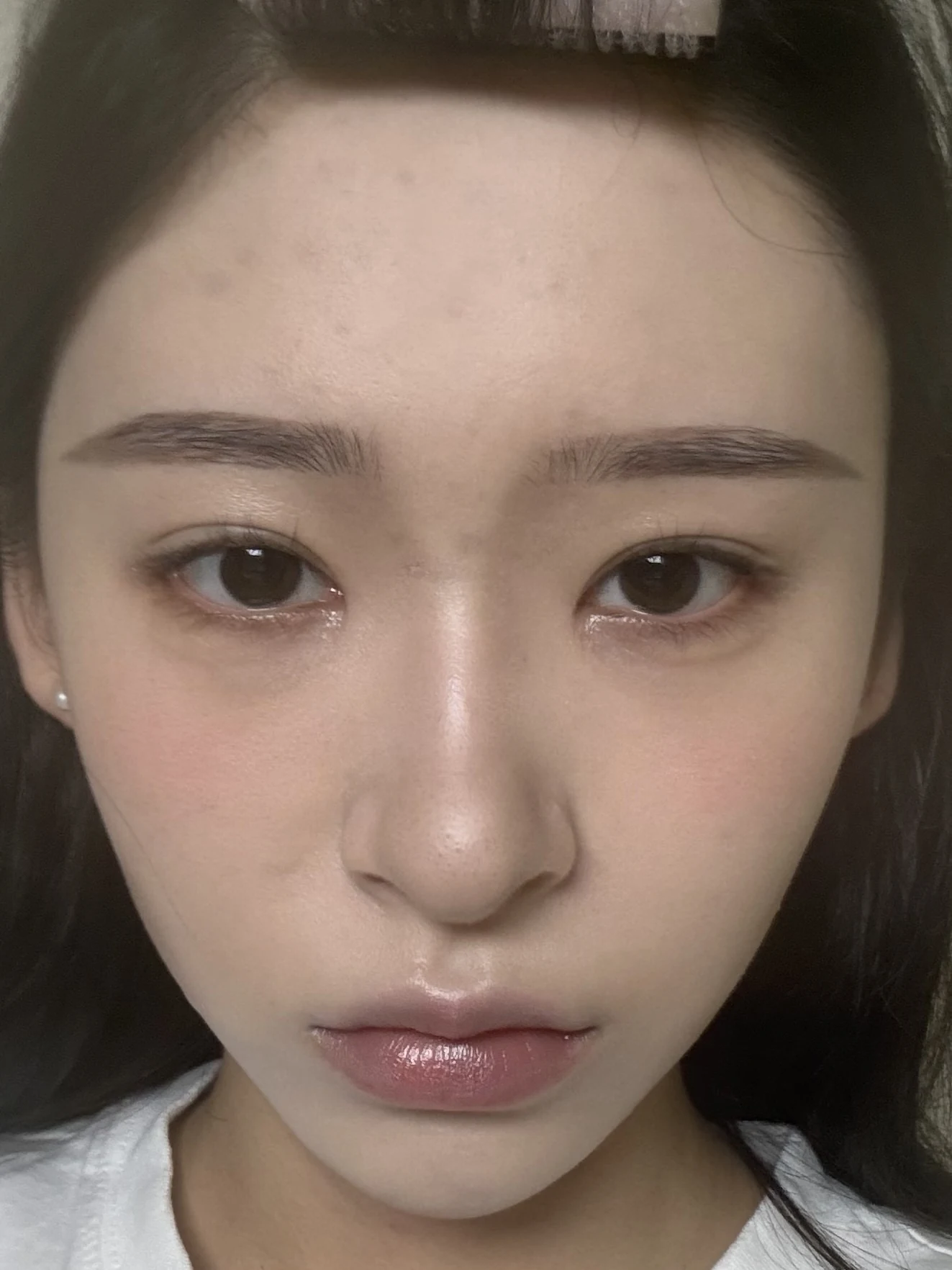 Eye-corner surgery: six-month recovery and smiling concerns · Case 089 at Answer Plastic Surgery. Front view — 2 months after surgery, eye-corner surgery at Answer Plastic Surgery (case 089).