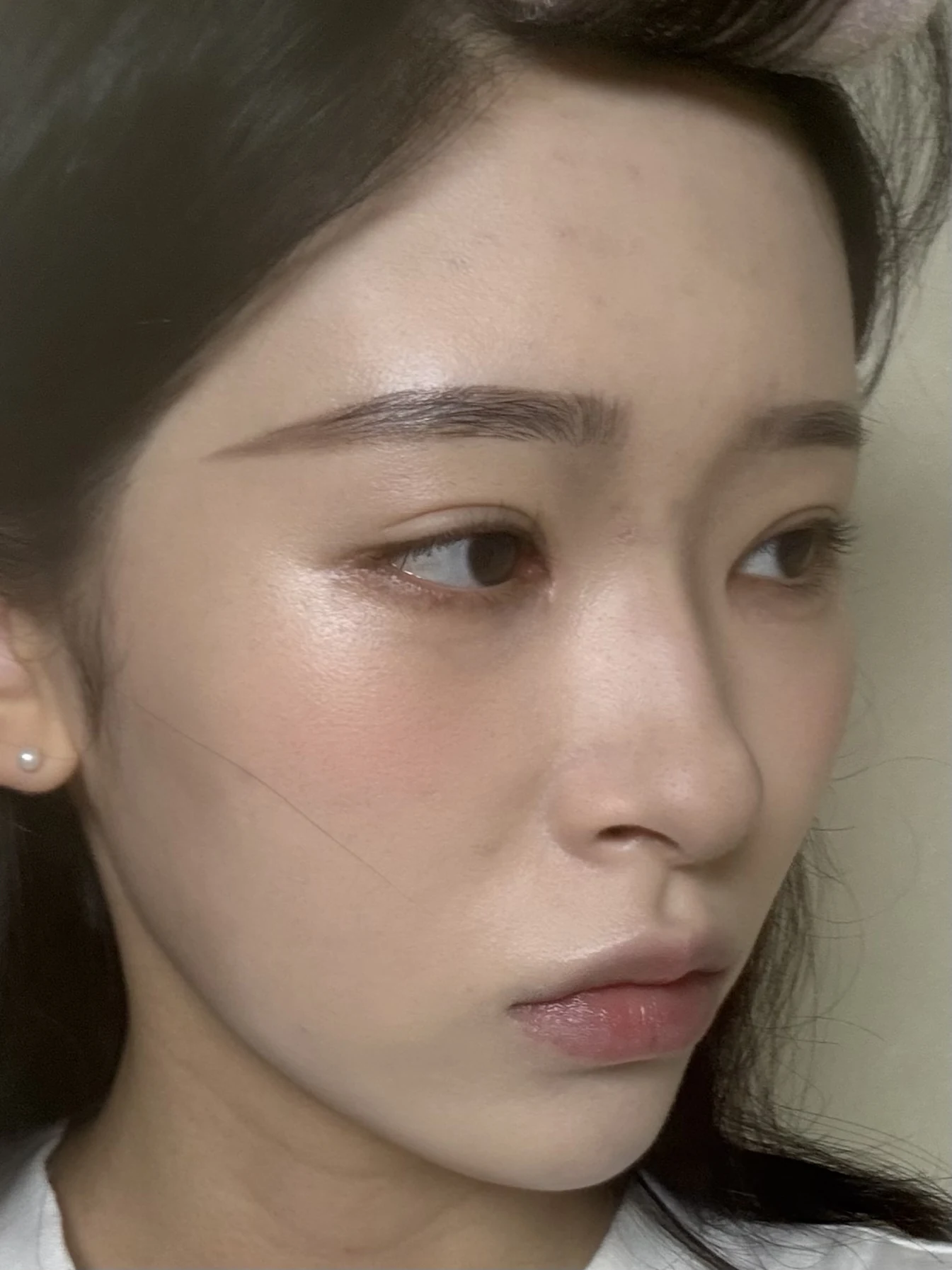 Eye-corner surgery: six-month recovery and smiling concerns · Case 089 at Answer Plastic Surgery. Oblique view — 2 months after surgery, eye-corner surgery at Answer Plastic Surgery (case 089).