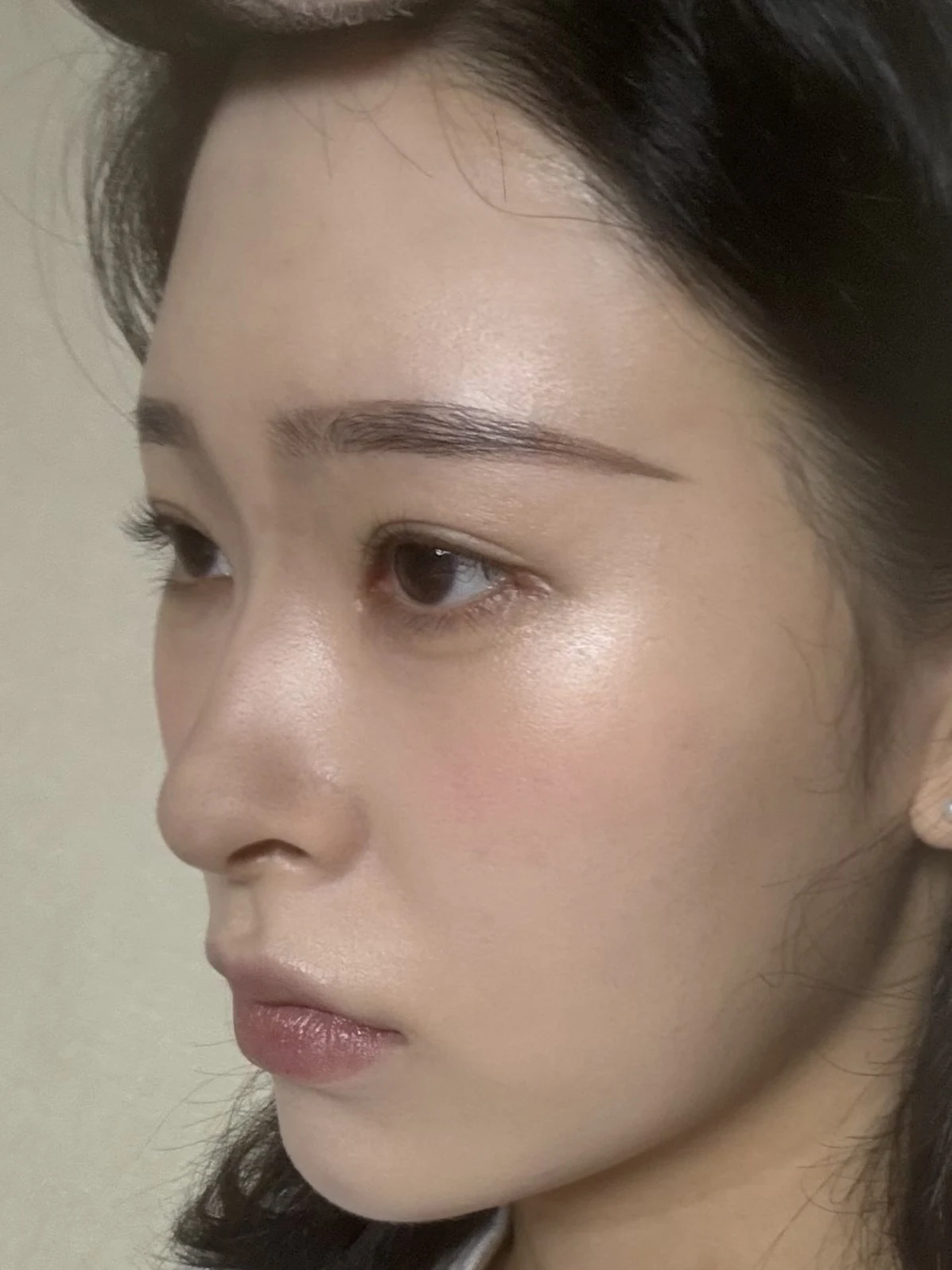 Eye-corner surgery: six-month recovery and smiling concerns · Case 089 at Answer Plastic Surgery. Opposite oblique view — 2 months after surgery, eye-corner surgery at Answer Plastic Surgery (case 089).