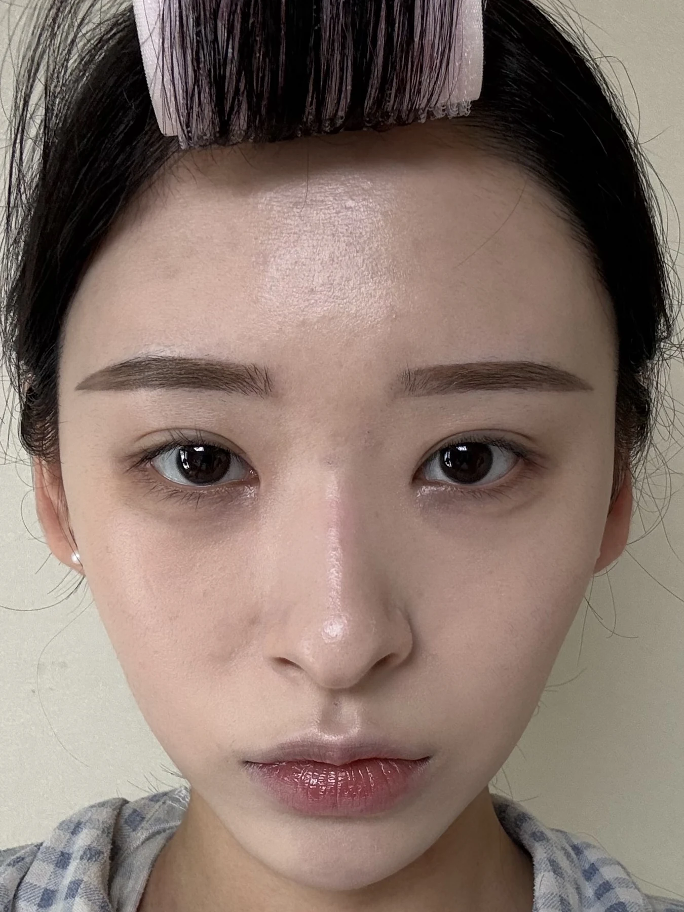 Eye-corner surgery: six-month recovery and smiling concerns · Case 089 at Answer Plastic Surgery. Front view — 3 months after surgery, eye-corner surgery at Answer Plastic Surgery (case 089).