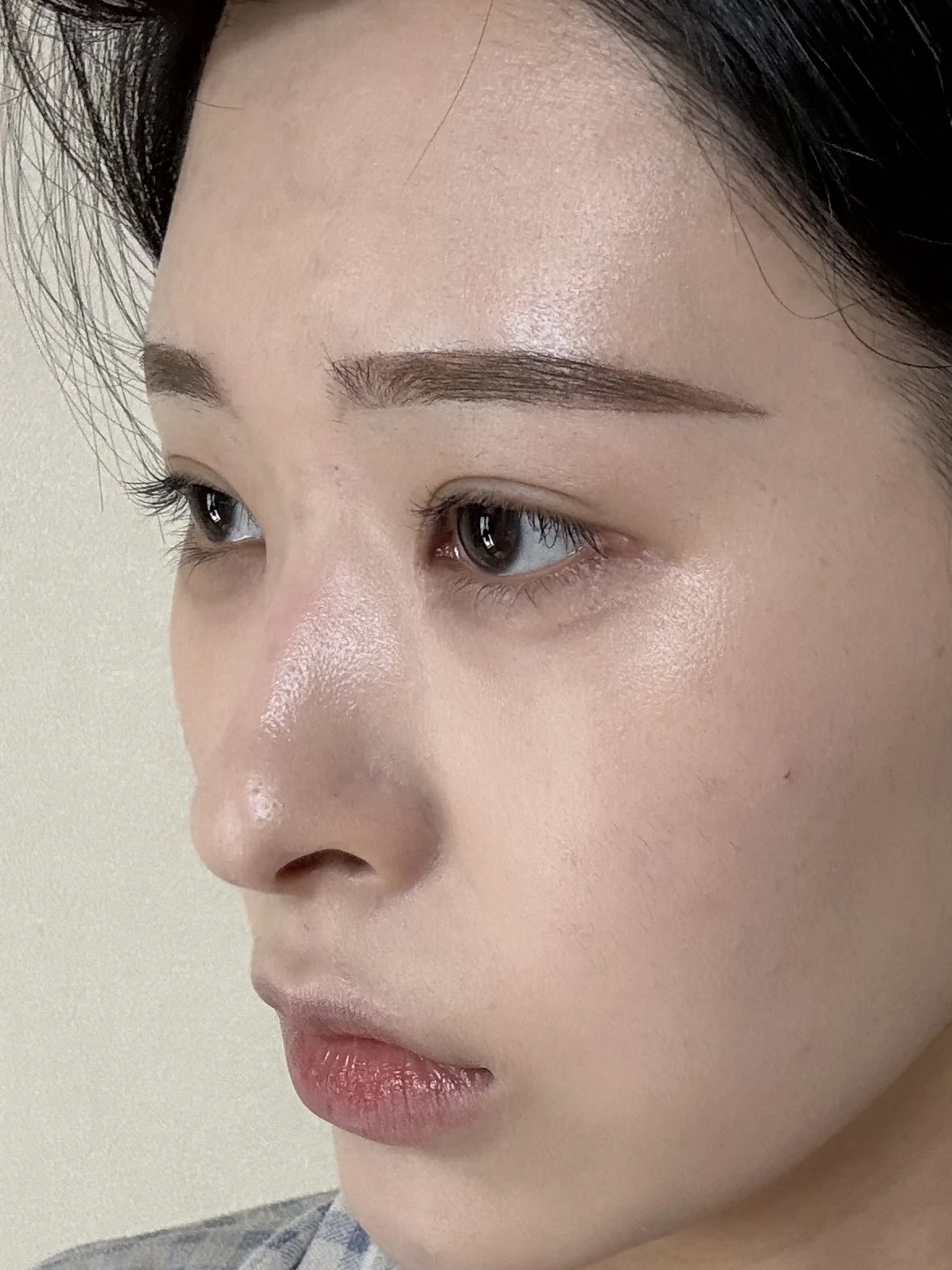 Eye-corner surgery: six-month recovery and smiling concerns · Case 089 at Answer Plastic Surgery. Oblique view — 3 months after surgery, eye-corner surgery at Answer Plastic Surgery (case 089).