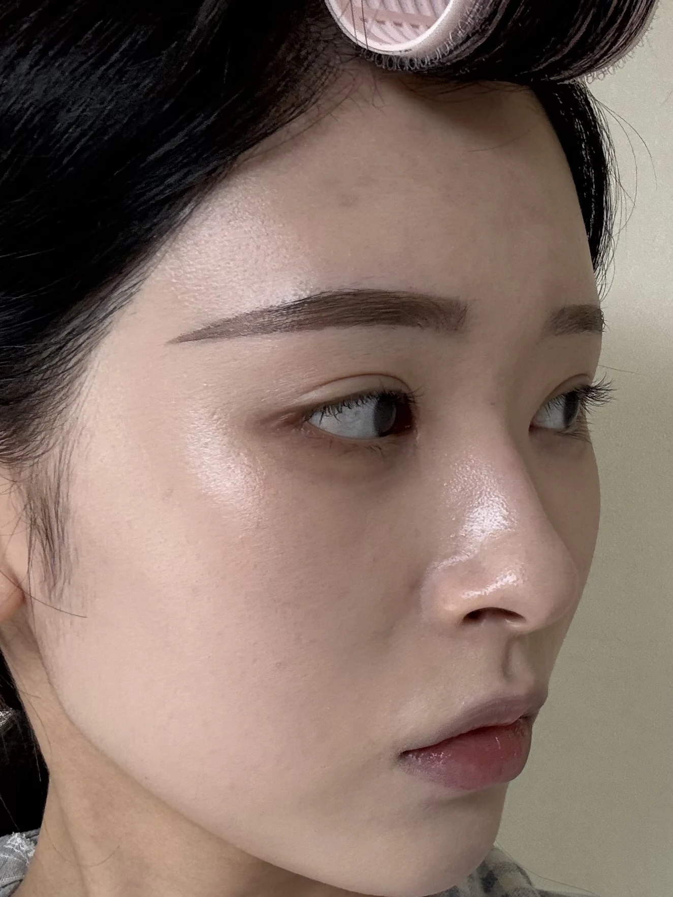 Eye-corner surgery: six-month recovery and smiling concerns · Case 089 at Answer Plastic Surgery. Opposite oblique view — 3 months after surgery, eye-corner surgery at Answer Plastic Surgery (case 089).