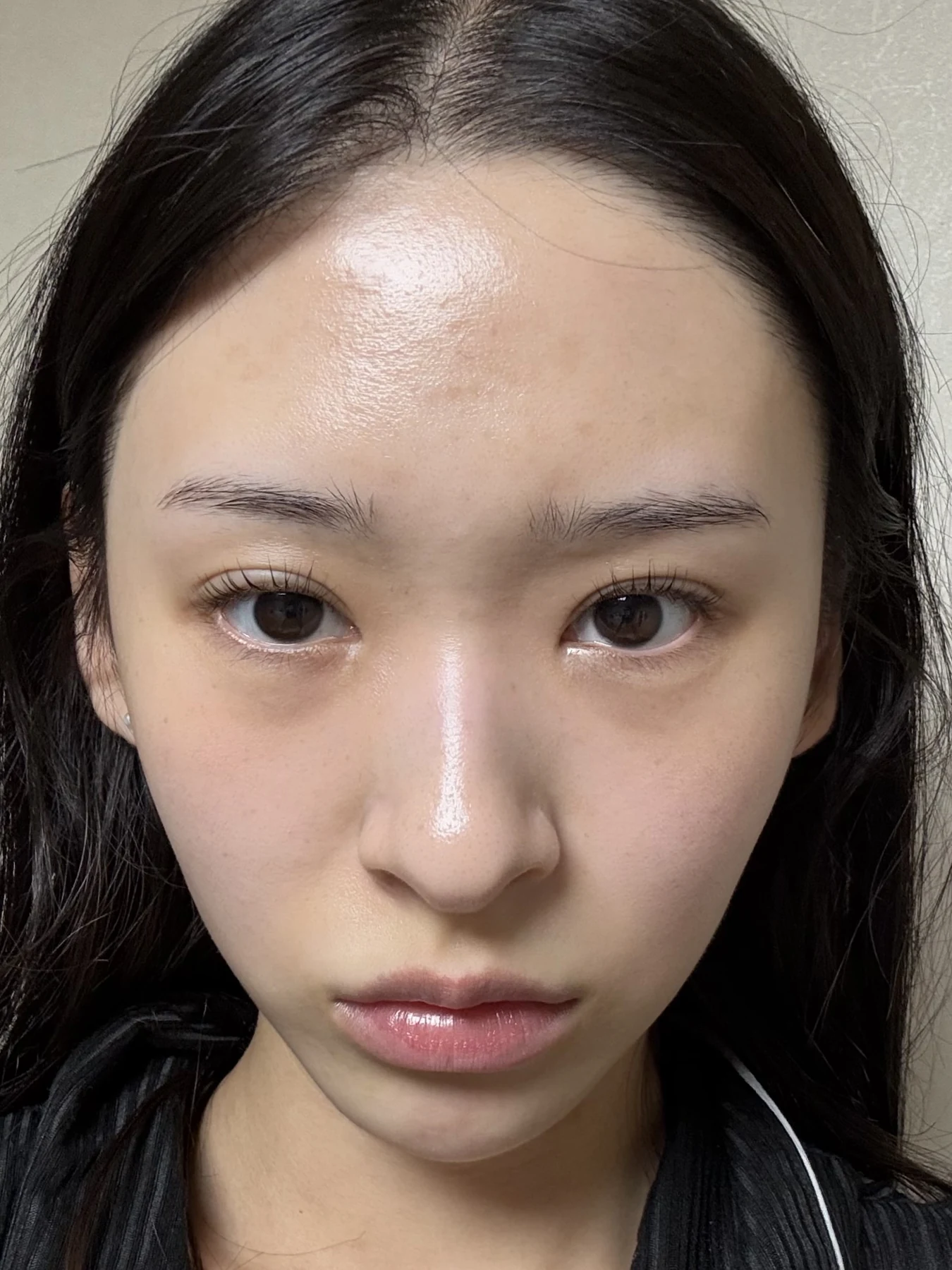 Eye-corner surgery: six-month recovery and smiling concerns · Case 089 at Answer Plastic Surgery. Front view — 6 months after surgery, eye-corner surgery at Answer Plastic Surgery (case 089).