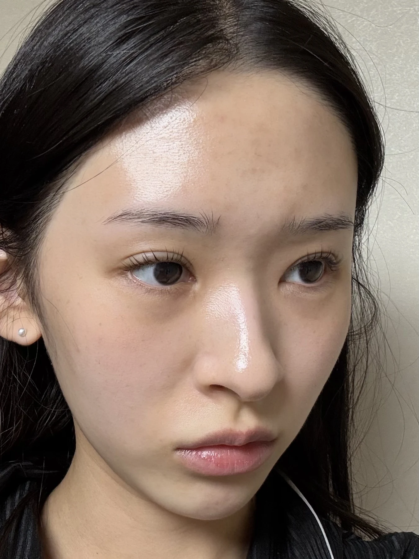 Eye-corner surgery: six-month recovery and smiling concerns · Case 089 at Answer Plastic Surgery. Oblique view — 6 months after surgery, eye-corner surgery at Answer Plastic Surgery (case 089).