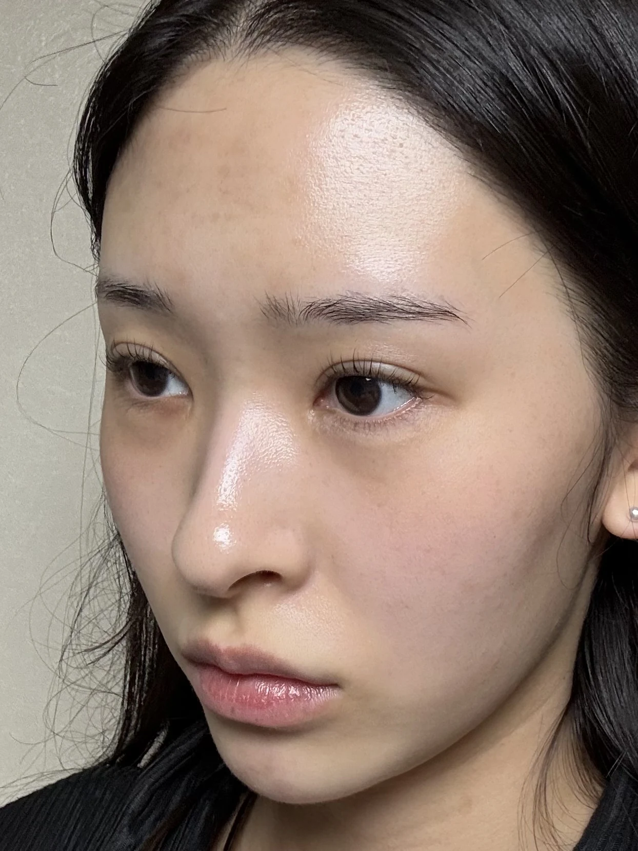 Eye-corner surgery: six-month recovery and smiling concerns · Case 089 at Answer Plastic Surgery. Opposite oblique view — 6 months after surgery, eye-corner surgery at Answer Plastic Surgery (case 089).