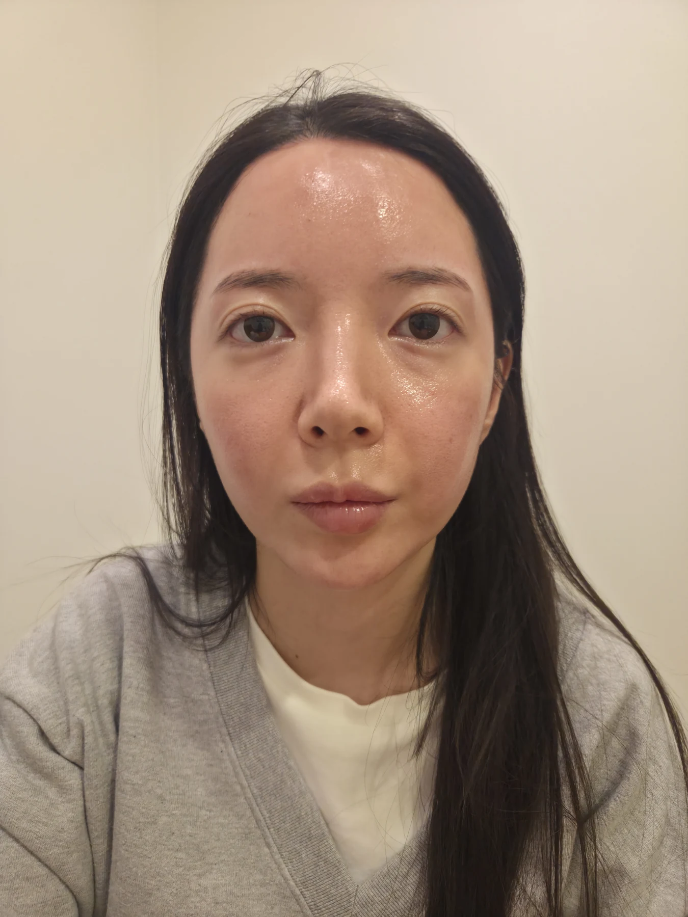 Eye-area surgery: recovery from surgery day to one month · Case 090 at Answer Plastic Surgery. Front view — before, eye-area surgery at Answer Plastic Surgery (case 090).