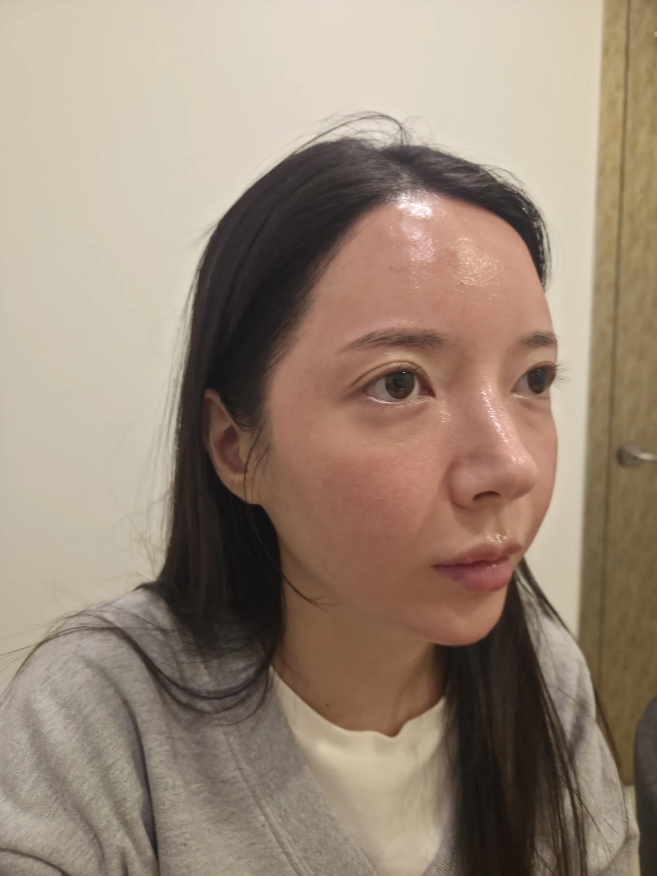 Eye-area surgery: recovery from surgery day to one month · Case 090 at Answer Plastic Surgery. Oblique view — before, eye-area surgery at Answer Plastic Surgery (case 090).