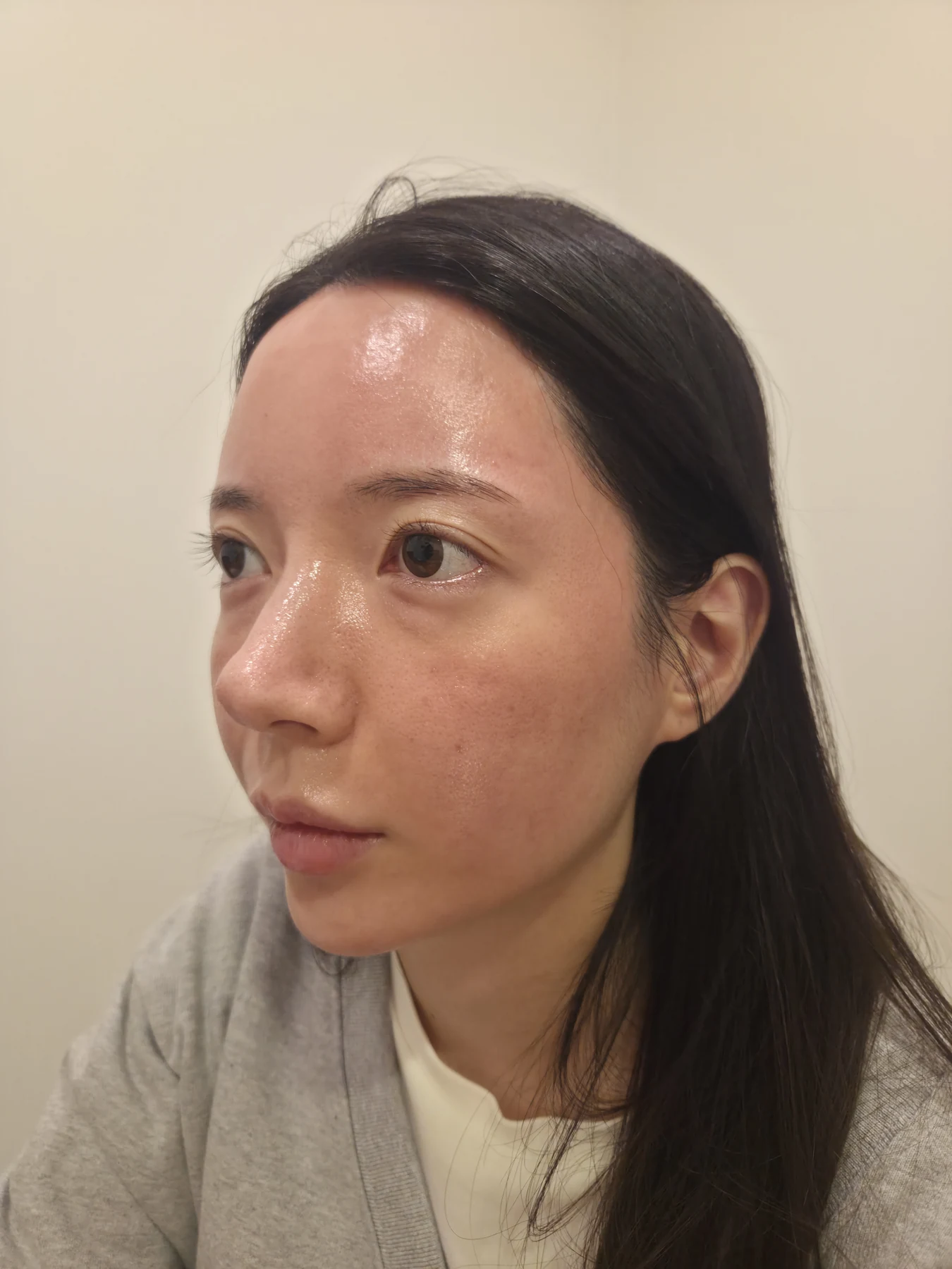 Eye-area surgery: recovery from surgery day to one month · Case 090 at Answer Plastic Surgery. Opposite oblique view — before, eye-area surgery at Answer Plastic Surgery (case 090).