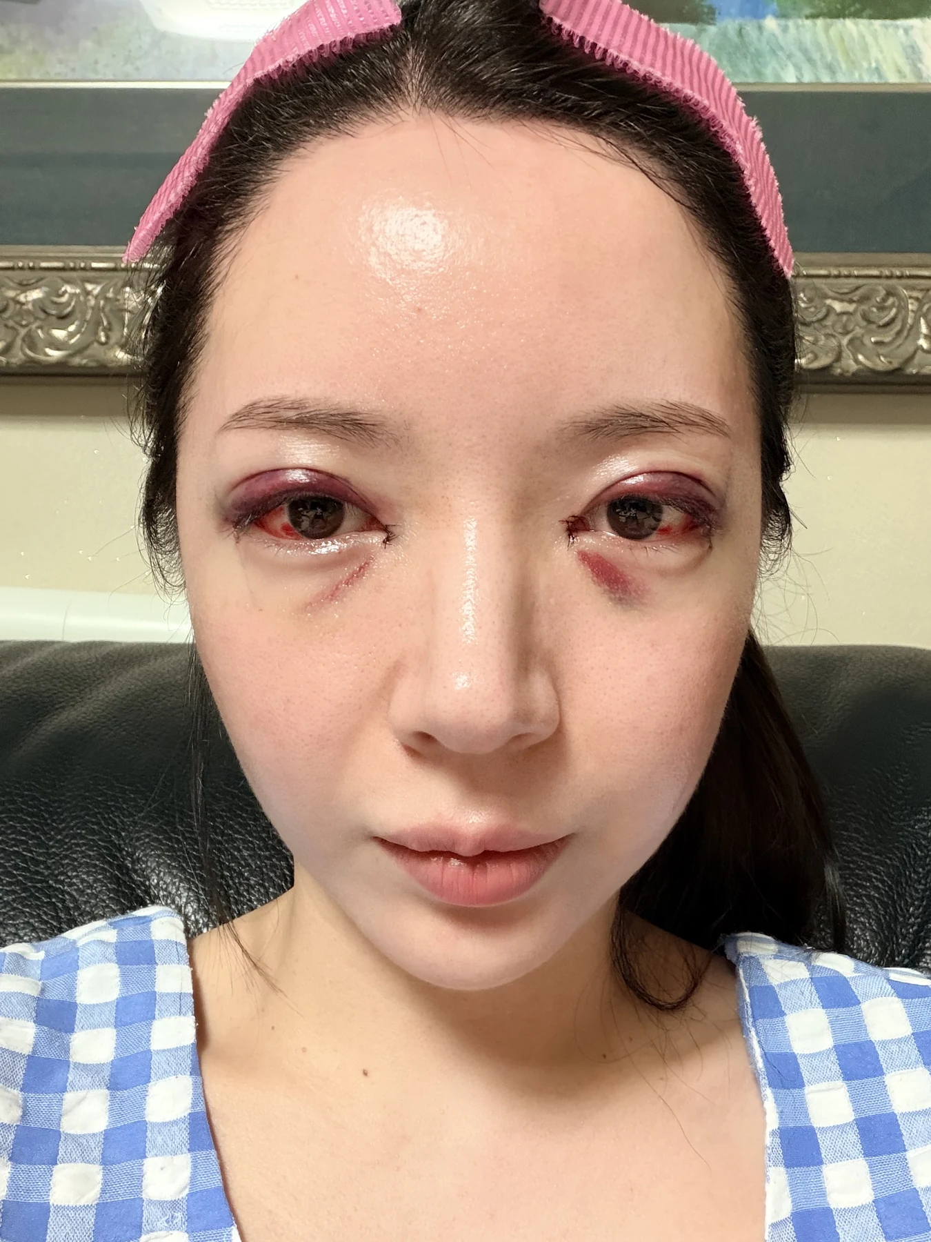 Eye-area surgery: recovery from surgery day to one month · Case 090 at Answer Plastic Surgery. Front view — surgery day, eye-area surgery at Answer Plastic Surgery (case 090).