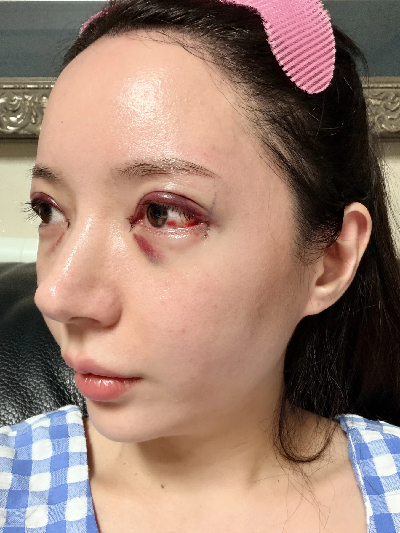 Eye-area surgery: recovery from surgery day to one month · Case 090 at Answer Plastic Surgery. Oblique view — surgery day, eye-area surgery at Answer Plastic Surgery (case 090).