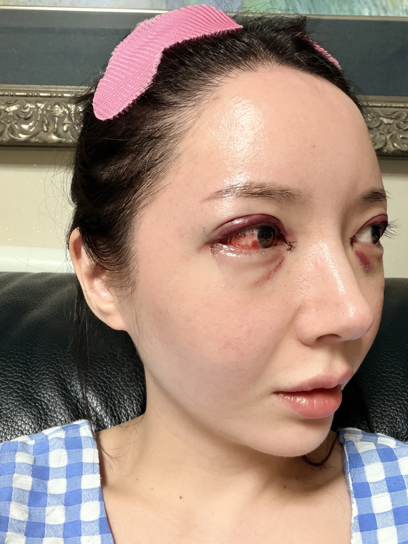 Eye-area surgery: recovery from surgery day to one month · Case 090 at Answer Plastic Surgery. Opposite oblique view — surgery day, eye-area surgery at Answer Plastic Surgery (case 090).