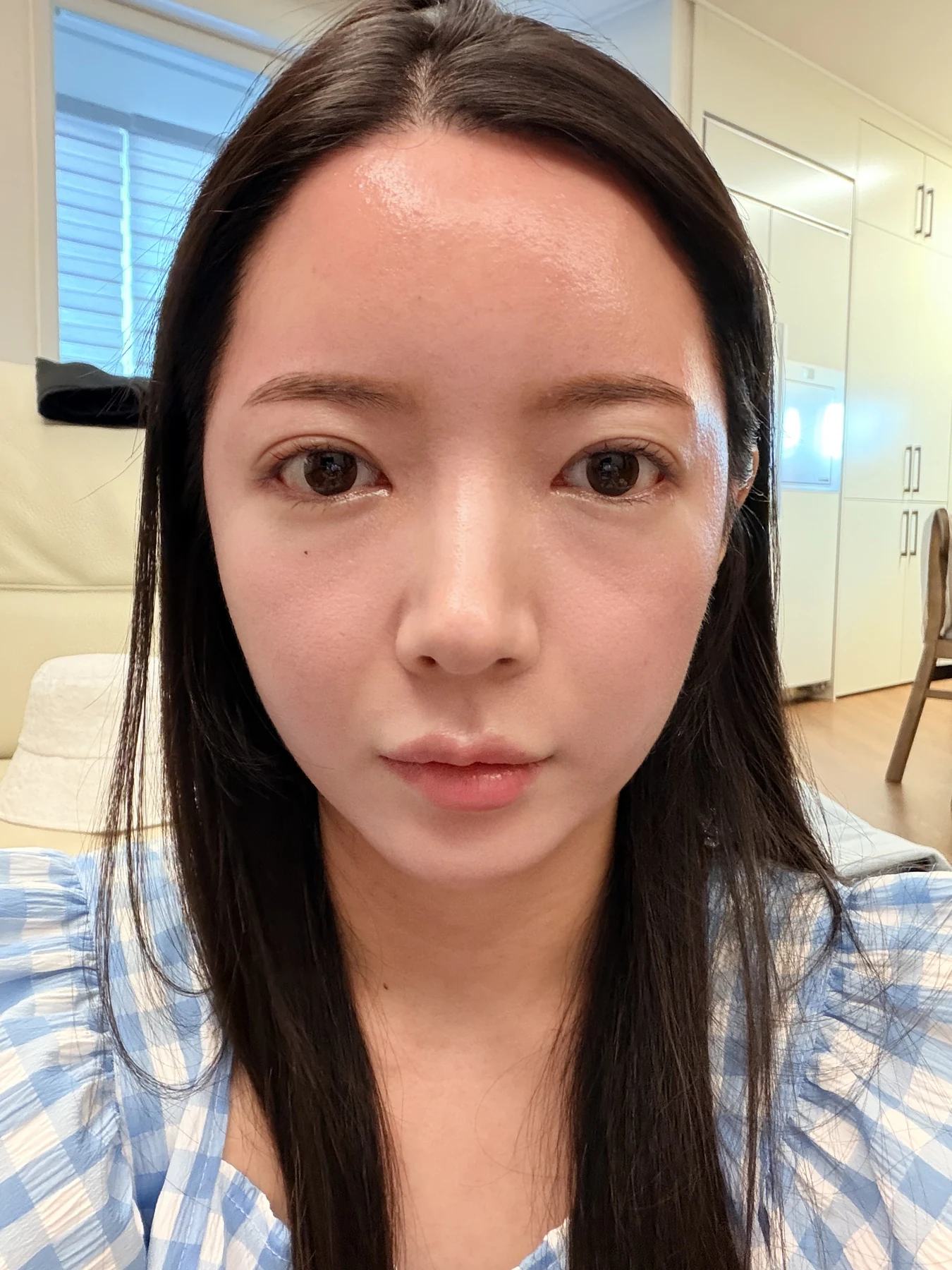 Eye-area surgery: recovery from surgery day to one month · Case 090 at Answer Plastic Surgery. Front view — 1 week after surgery, eye-area surgery at Answer Plastic Surgery (case 090).