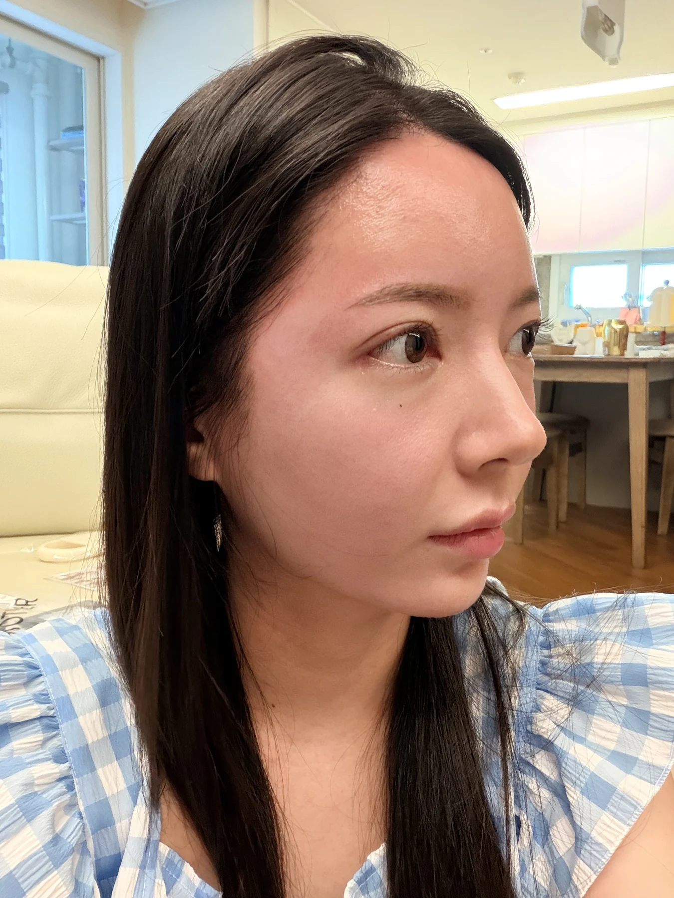 Eye-area surgery: recovery from surgery day to one month · Case 090 at Answer Plastic Surgery. Oblique view — 1 week after surgery, eye-area surgery at Answer Plastic Surgery (case 090).