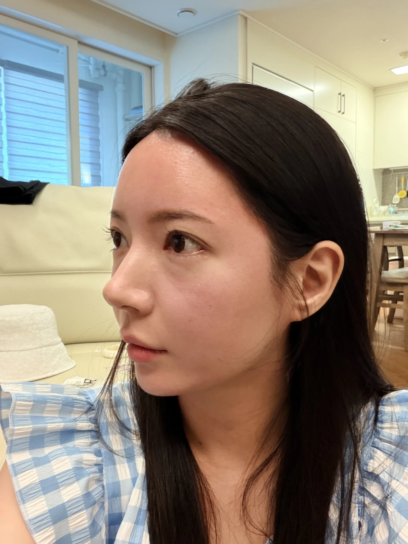 Eye-area surgery: recovery from surgery day to one month · Case 090 at Answer Plastic Surgery. Opposite oblique view — 1 week after surgery, eye-area surgery at Answer Plastic Surgery (case 090).