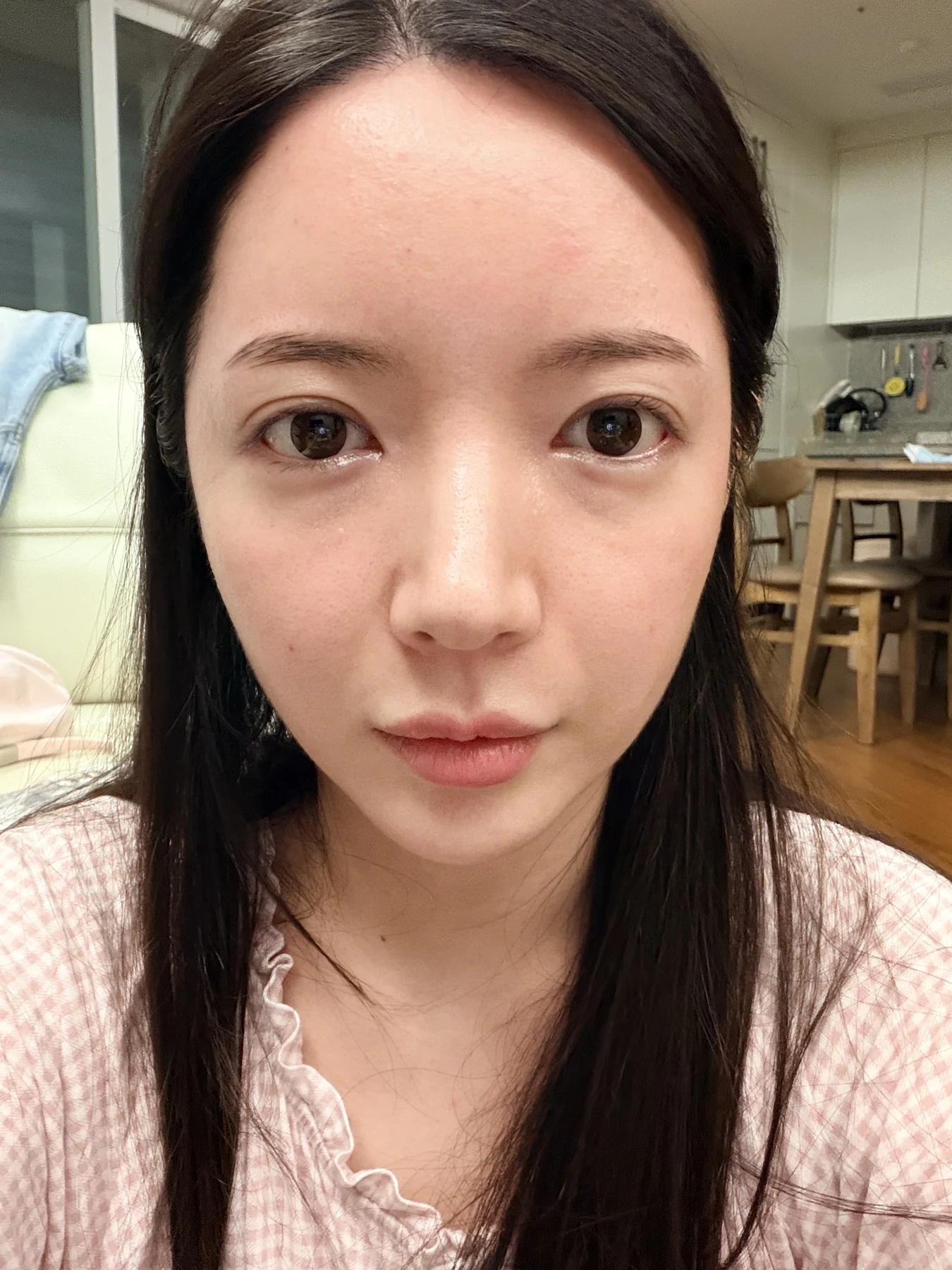 Eye-area surgery: recovery from surgery day to one month · Case 090 at Answer Plastic Surgery. Front view — 2 weeks after surgery, eye-area surgery at Answer Plastic Surgery (case 090).