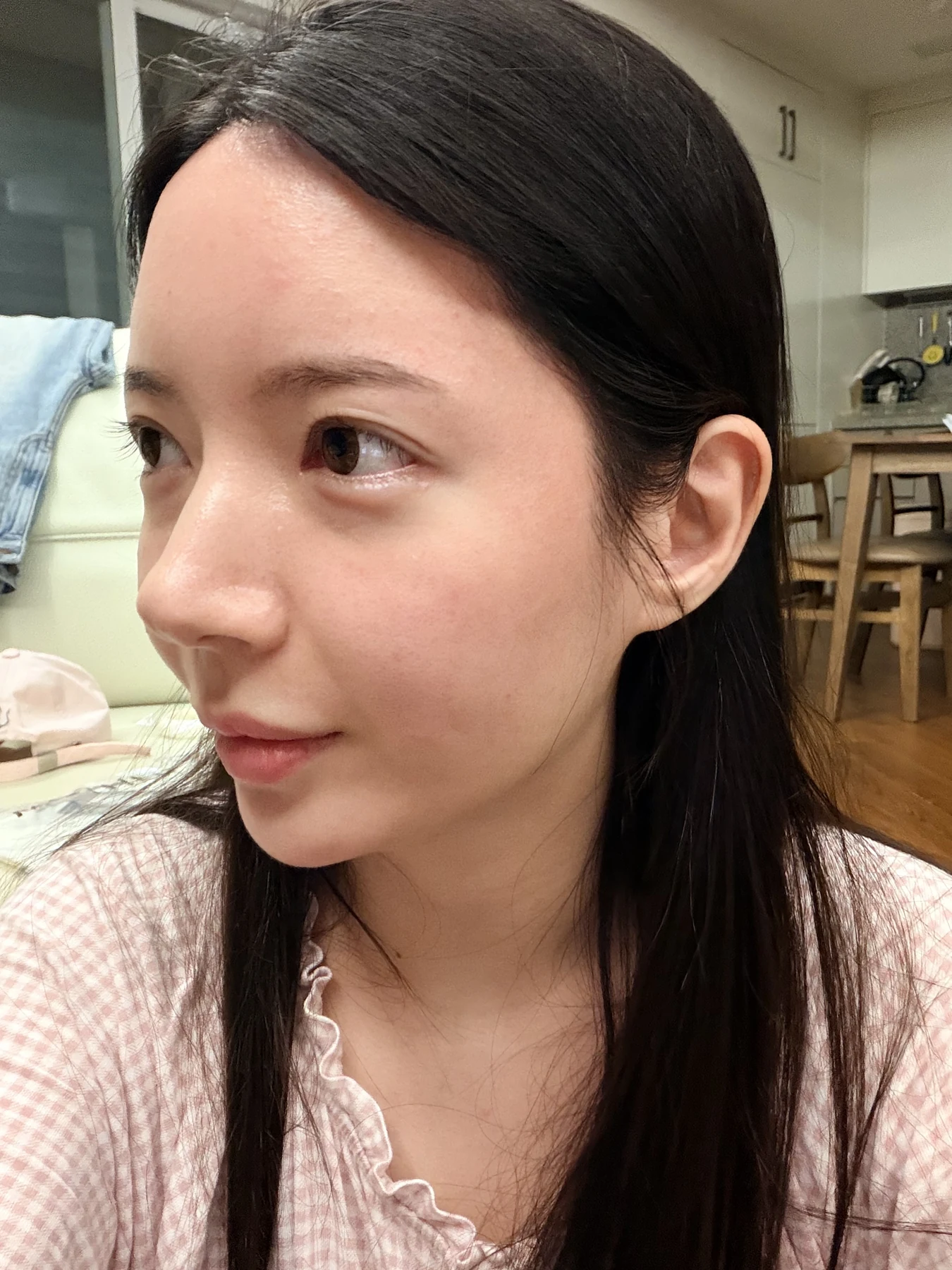 Eye-area surgery: recovery from surgery day to one month · Case 090 at Answer Plastic Surgery. Oblique view — 2 weeks after surgery, eye-area surgery at Answer Plastic Surgery (case 090).