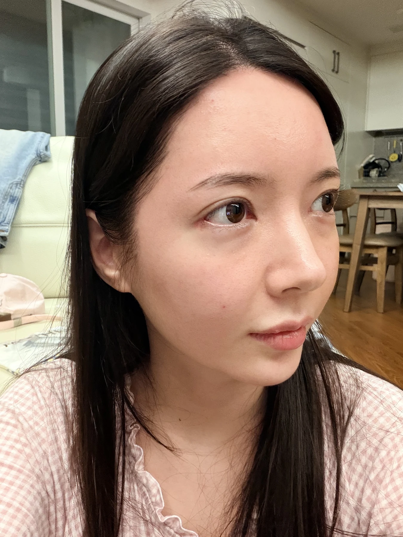 Eye-area surgery: recovery from surgery day to one month · Case 090 at Answer Plastic Surgery. Opposite oblique view — 2 weeks after surgery, eye-area surgery at Answer Plastic Surgery (case 090).