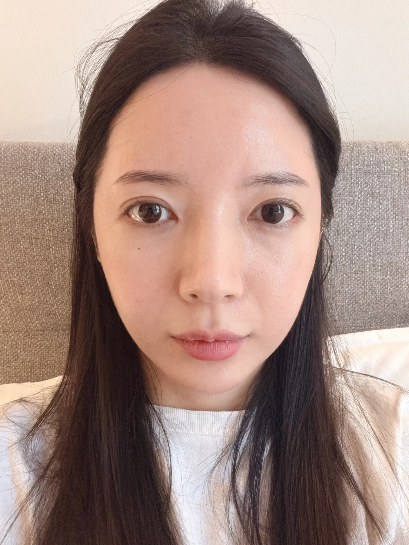 Eye-area surgery: recovery from surgery day to one month · Case 090 at Answer Plastic Surgery. Front view — 3 weeks after surgery, eye-area surgery at Answer Plastic Surgery (case 090).