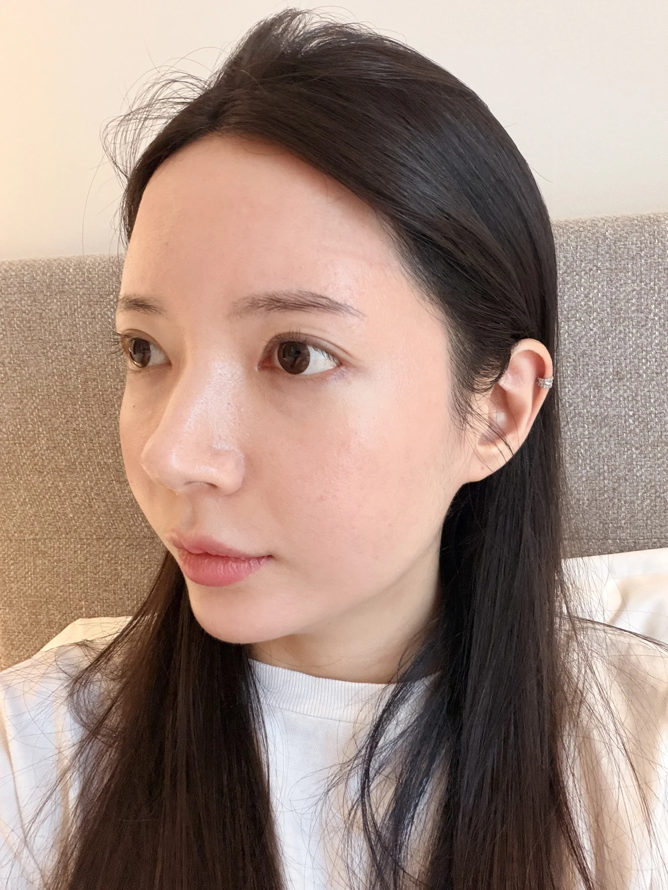 Eye-area surgery: recovery from surgery day to one month · Case 090 at Answer Plastic Surgery. Oblique view — 3 weeks after surgery, eye-area surgery at Answer Plastic Surgery (case 090).