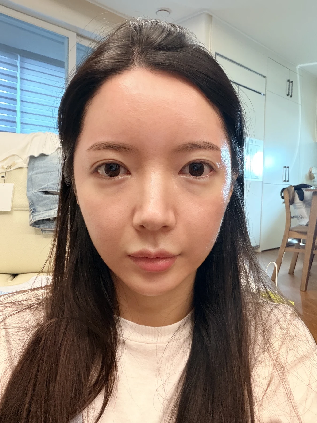Eye-area surgery: recovery from surgery day to one month · Case 090 at Answer Plastic Surgery. Front view — 1 month after surgery, eye-area surgery at Answer Plastic Surgery (case 090).
