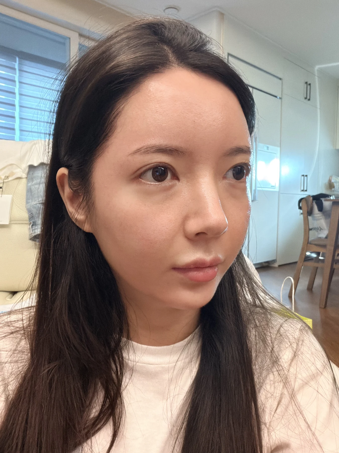 Eye-area surgery: recovery from surgery day to one month · Case 090 at Answer Plastic Surgery. Oblique view — 1 month after surgery, eye-area surgery at Answer Plastic Surgery (case 090).