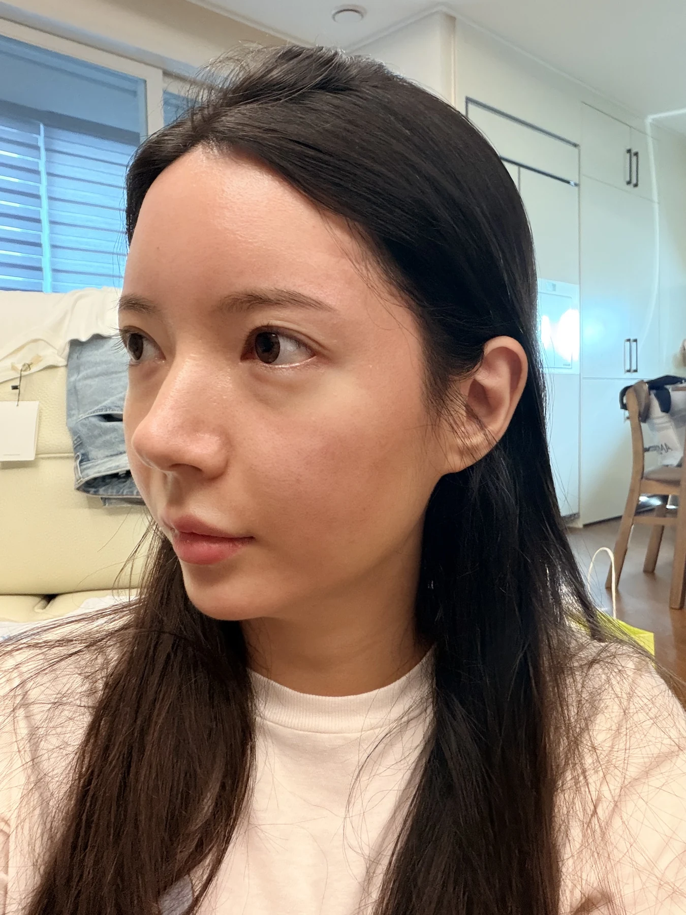 Eye-area surgery: recovery from surgery day to one month · Case 090 at Answer Plastic Surgery. Opposite oblique view — 1 month after surgery, eye-area surgery at Answer Plastic Surgery (case 090).