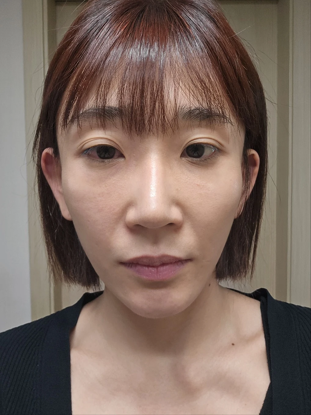 Incisional eye-opening correction and lateral canthoplasty: three months · Case 091 at Answer Plastic Surgery. Front view — before, incisional eye-opening correction and lateral canthoplasty at Answer Plastic Surgery (case 091).