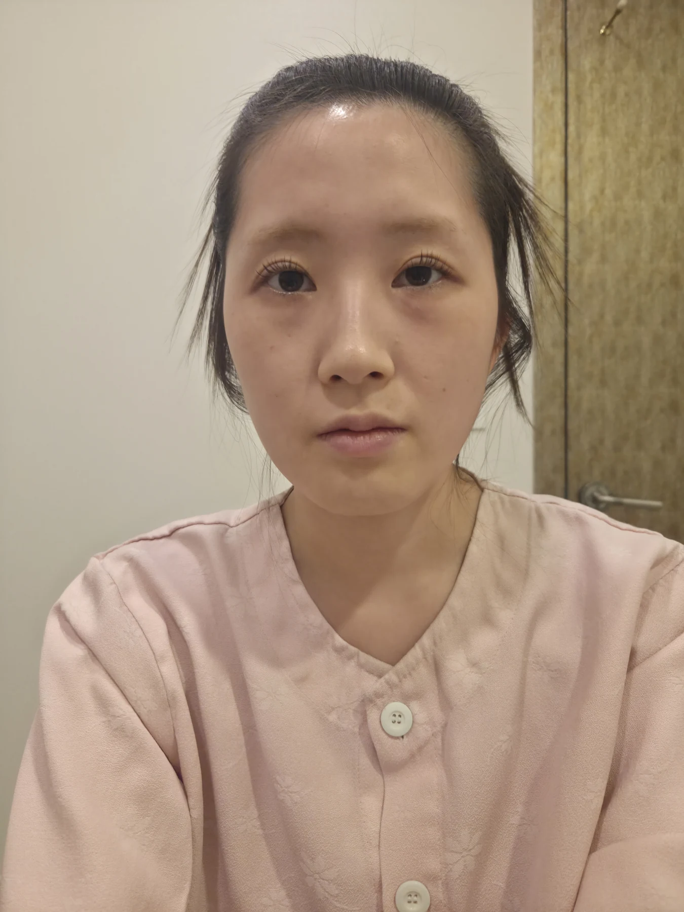 Eye-area surgery: patient observations through three months · Case 092 at Answer Plastic Surgery. Front view — before, eye-area surgery at Answer Plastic Surgery (case 092).