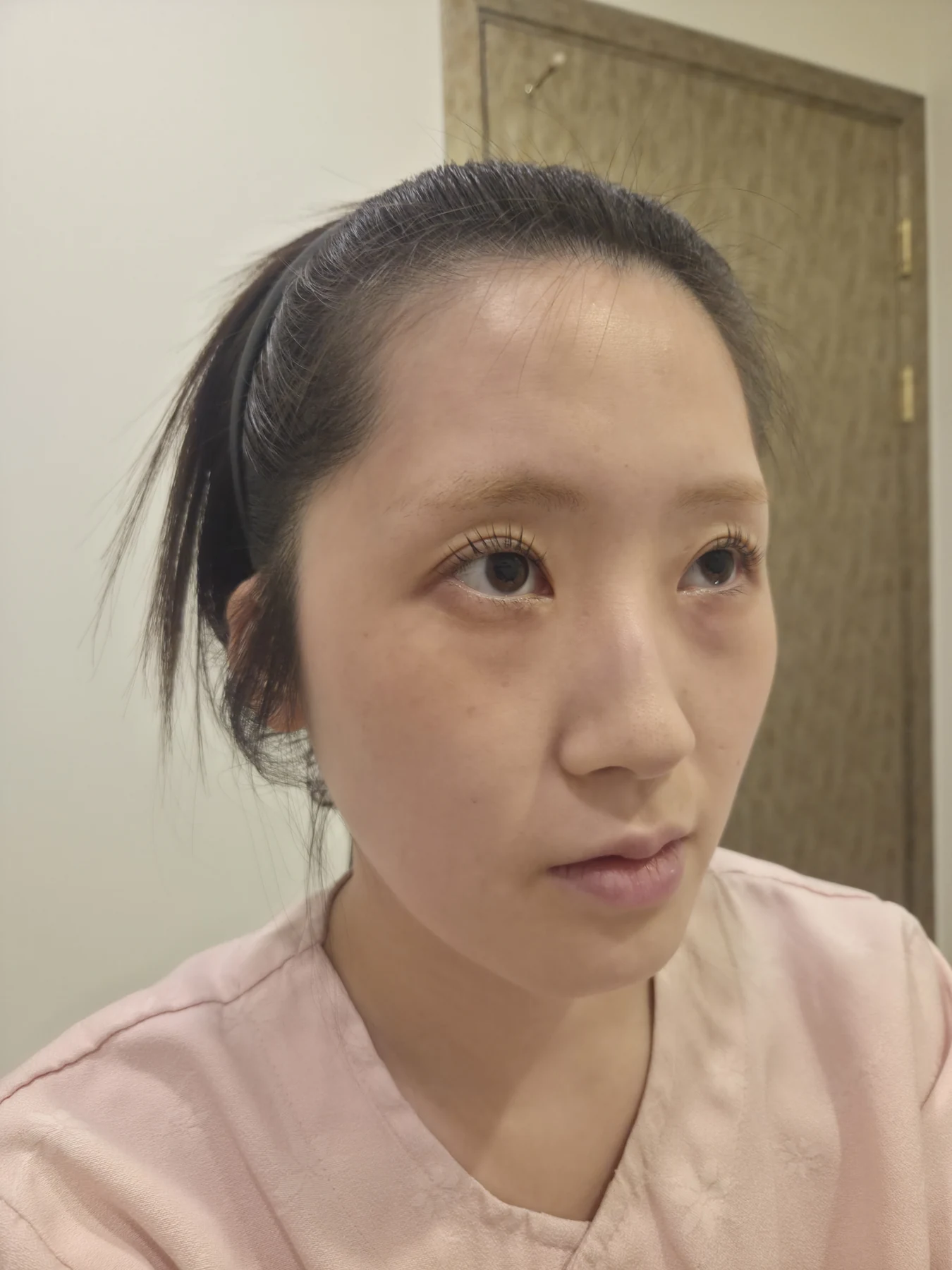Eye-area surgery: patient observations through three months · Case 092 at Answer Plastic Surgery. Oblique view — before, eye-area surgery at Answer Plastic Surgery (case 092).