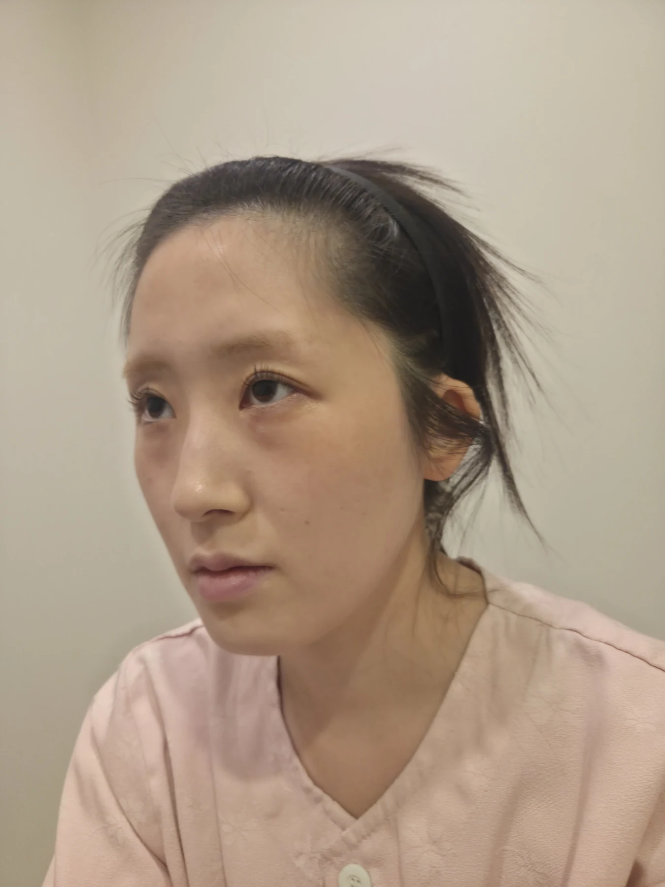 Eye-area surgery: patient observations through three months · Case 092 at Answer Plastic Surgery. Opposite oblique view — before, eye-area surgery at Answer Plastic Surgery (case 092).