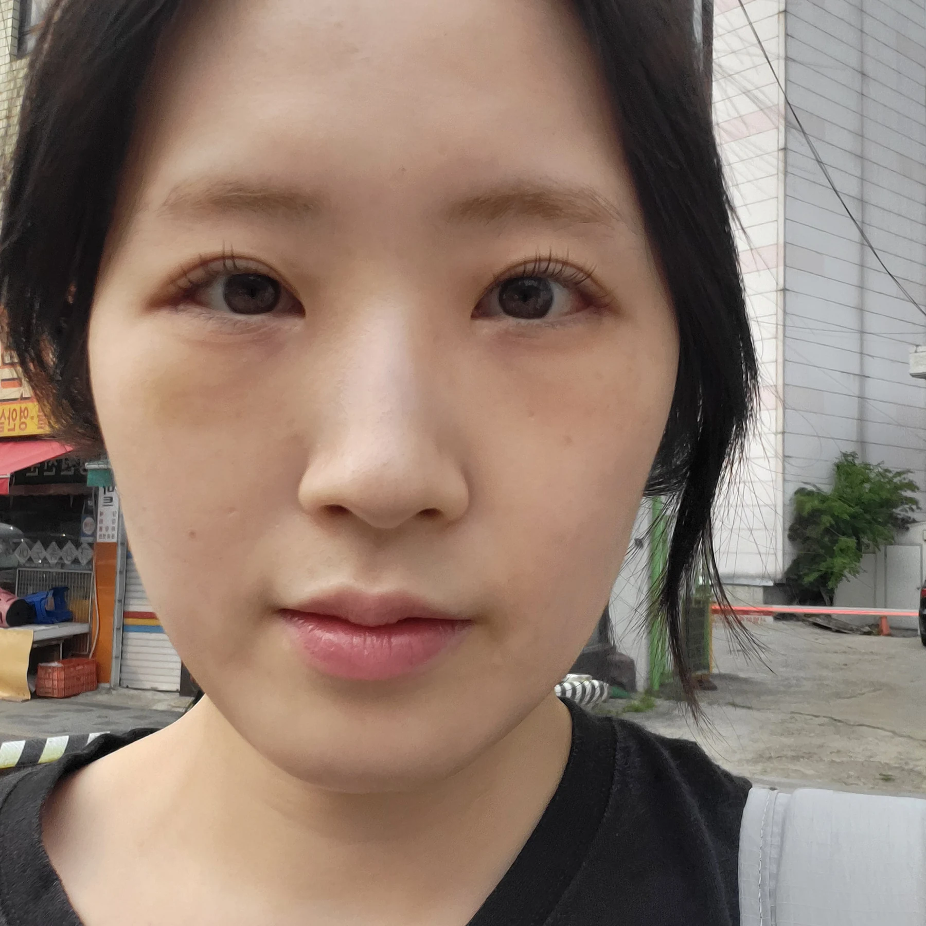 Eye-area surgery: patient observations through three months · Case 092 at Answer Plastic Surgery. Front view — 2 weeks after surgery, eye-area surgery at Answer Plastic Surgery (case 092).