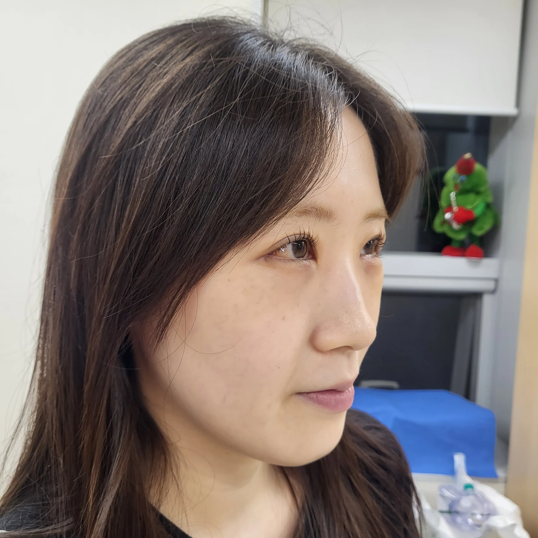 Eye-area surgery: patient observations through three months · Case 092 at Answer Plastic Surgery. Oblique view — 2 weeks after surgery, eye-area surgery at Answer Plastic Surgery (case 092).