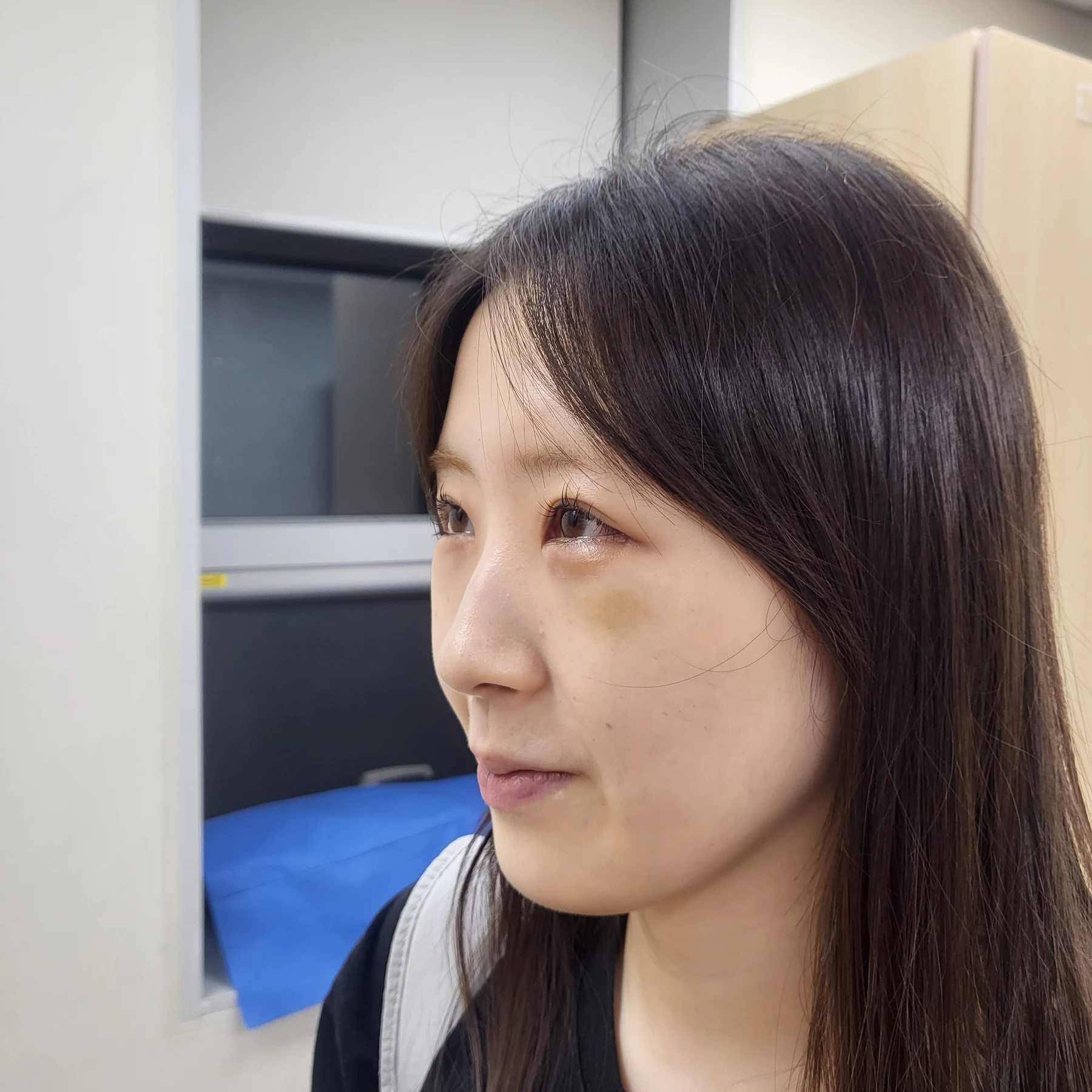 Eye-area surgery: patient observations through three months · Case 092 at Answer Plastic Surgery. Opposite oblique view — 2 weeks after surgery, eye-area surgery at Answer Plastic Surgery (case 092).