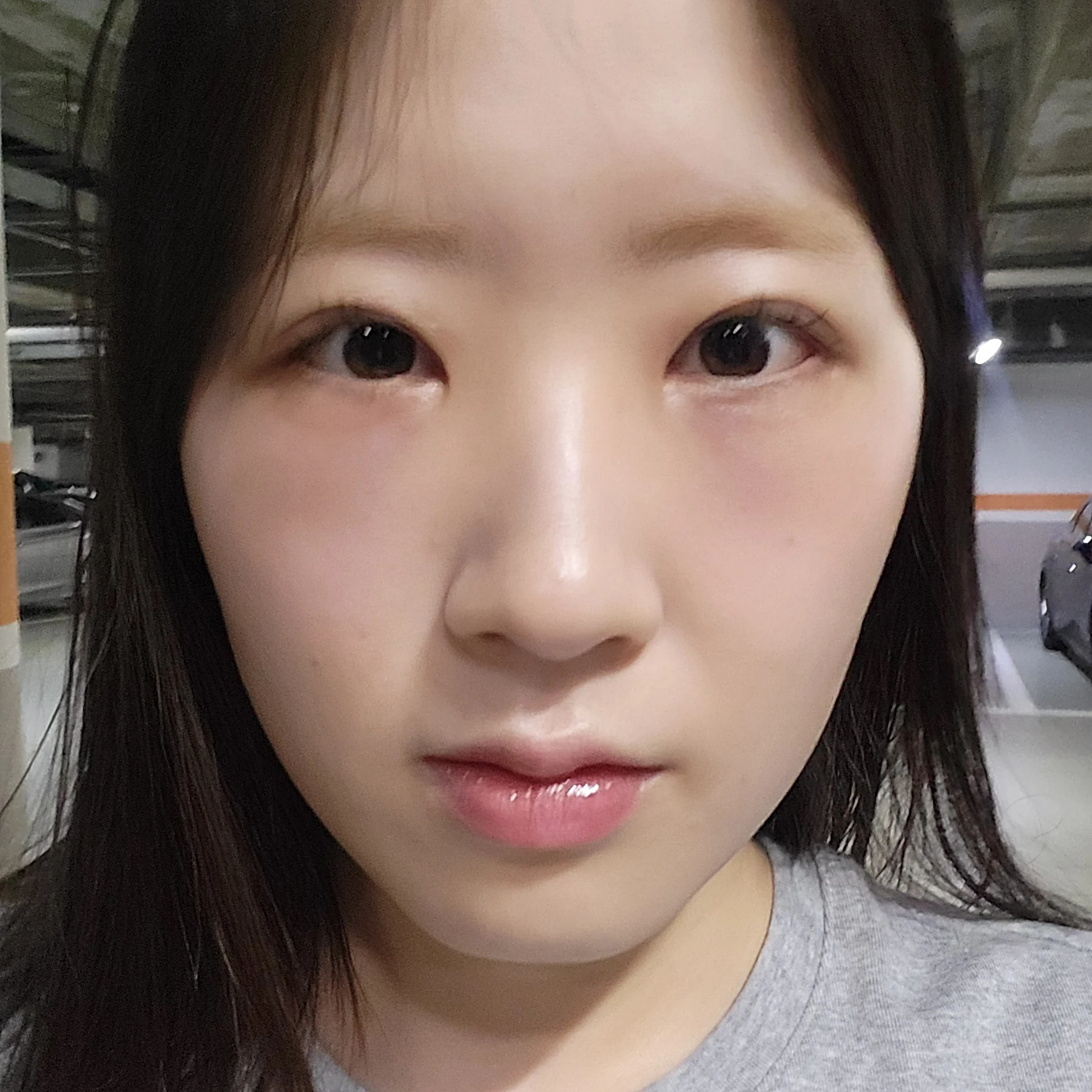 Eye-area surgery: patient observations through three months · Case 092 at Answer Plastic Surgery. Front view — 3 weeks after surgery, eye-area surgery at Answer Plastic Surgery (case 092).
