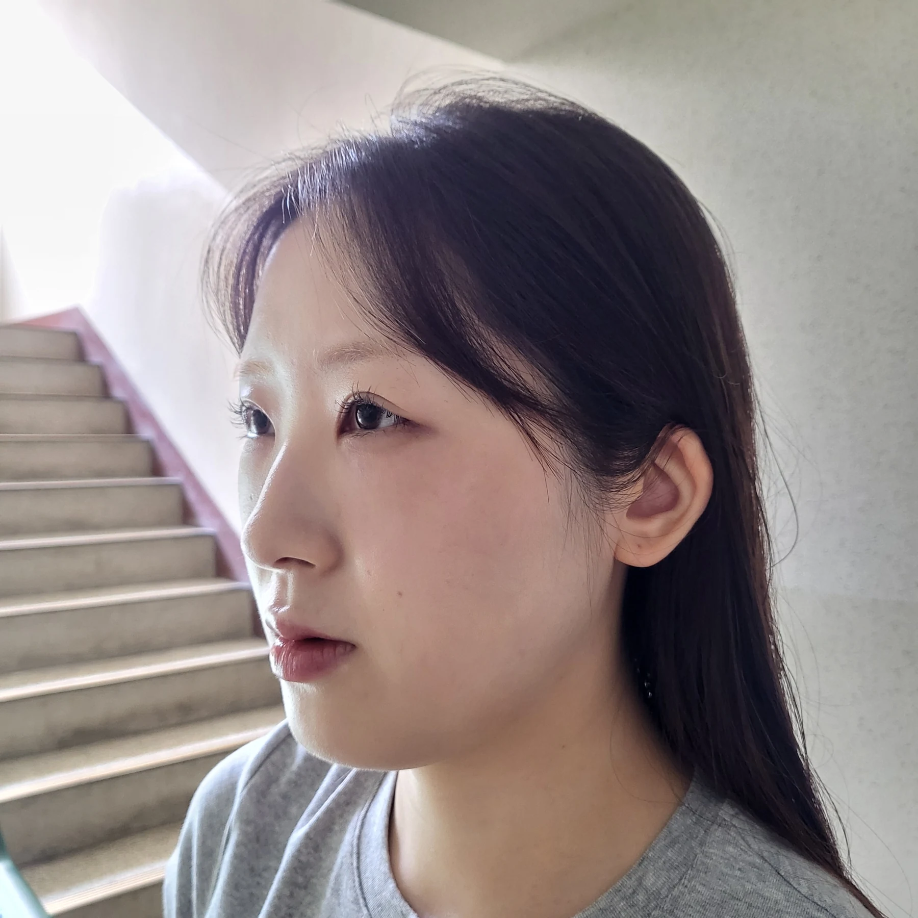 Eye-area surgery: patient observations through three months · Case 092 at Answer Plastic Surgery. Opposite oblique view — 3 weeks after surgery, eye-area surgery at Answer Plastic Surgery (case 092).