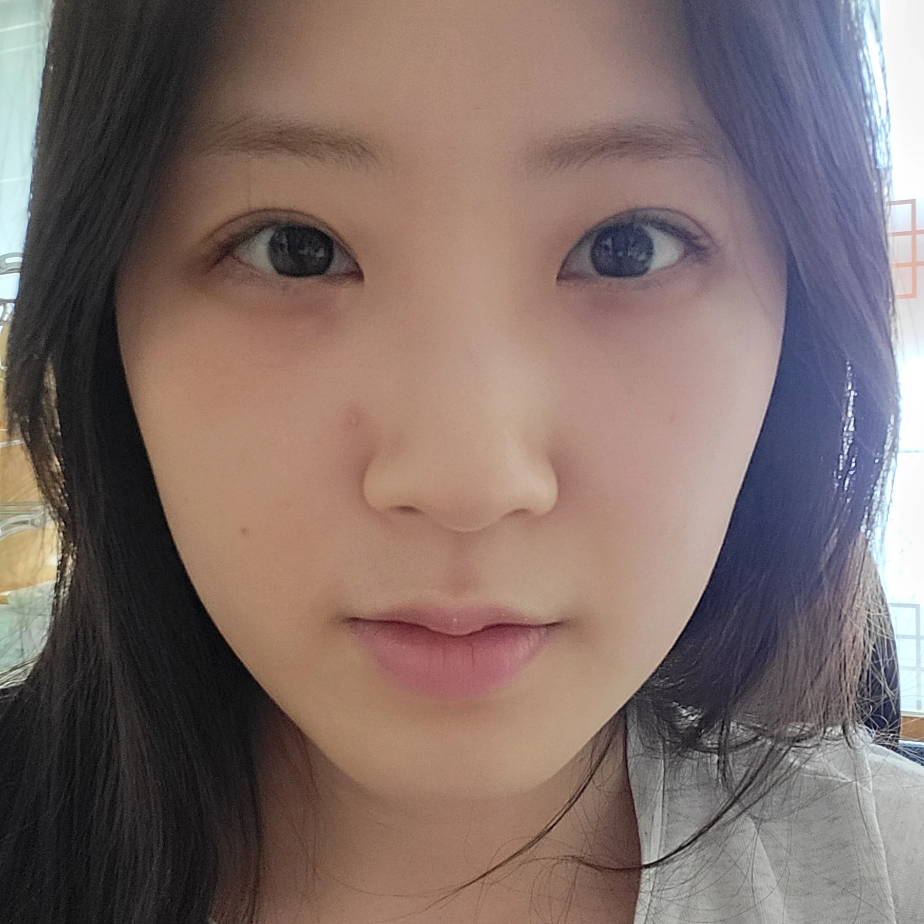 Eye-area surgery: patient observations through three months · Case 092 at Answer Plastic Surgery. Front view — 1 month after surgery, eye-area surgery at Answer Plastic Surgery (case 092).