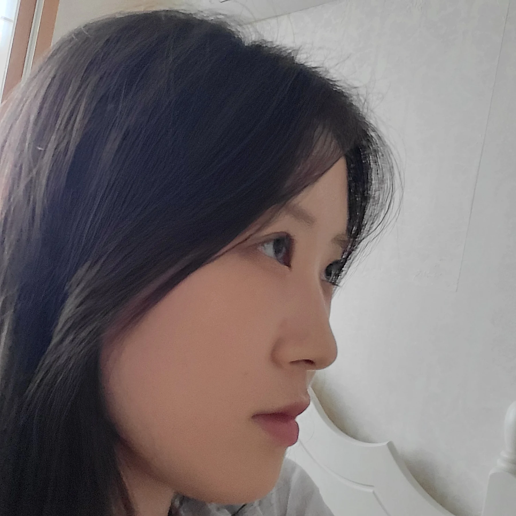 Eye-area surgery: patient observations through three months · Case 092 at Answer Plastic Surgery. Oblique view — 1 month after surgery, eye-area surgery at Answer Plastic Surgery (case 092).