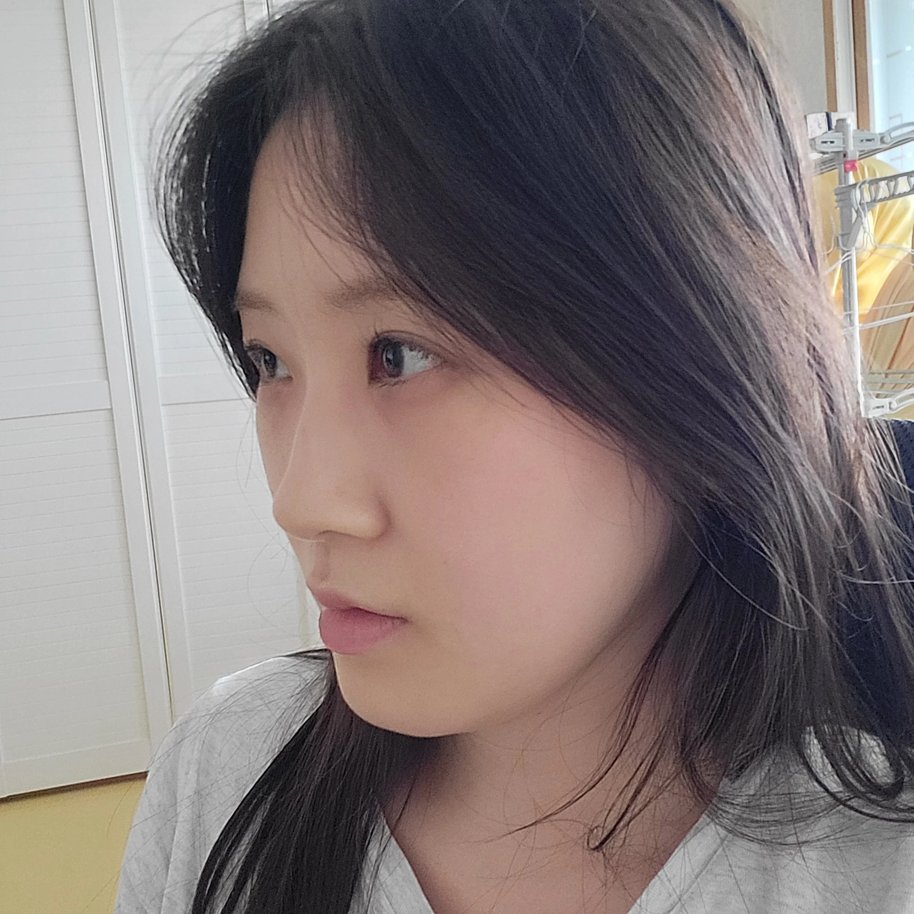 Eye-area surgery: patient observations through three months · Case 092 at Answer Plastic Surgery. Opposite oblique view — 1 month after surgery, eye-area surgery at Answer Plastic Surgery (case 092).