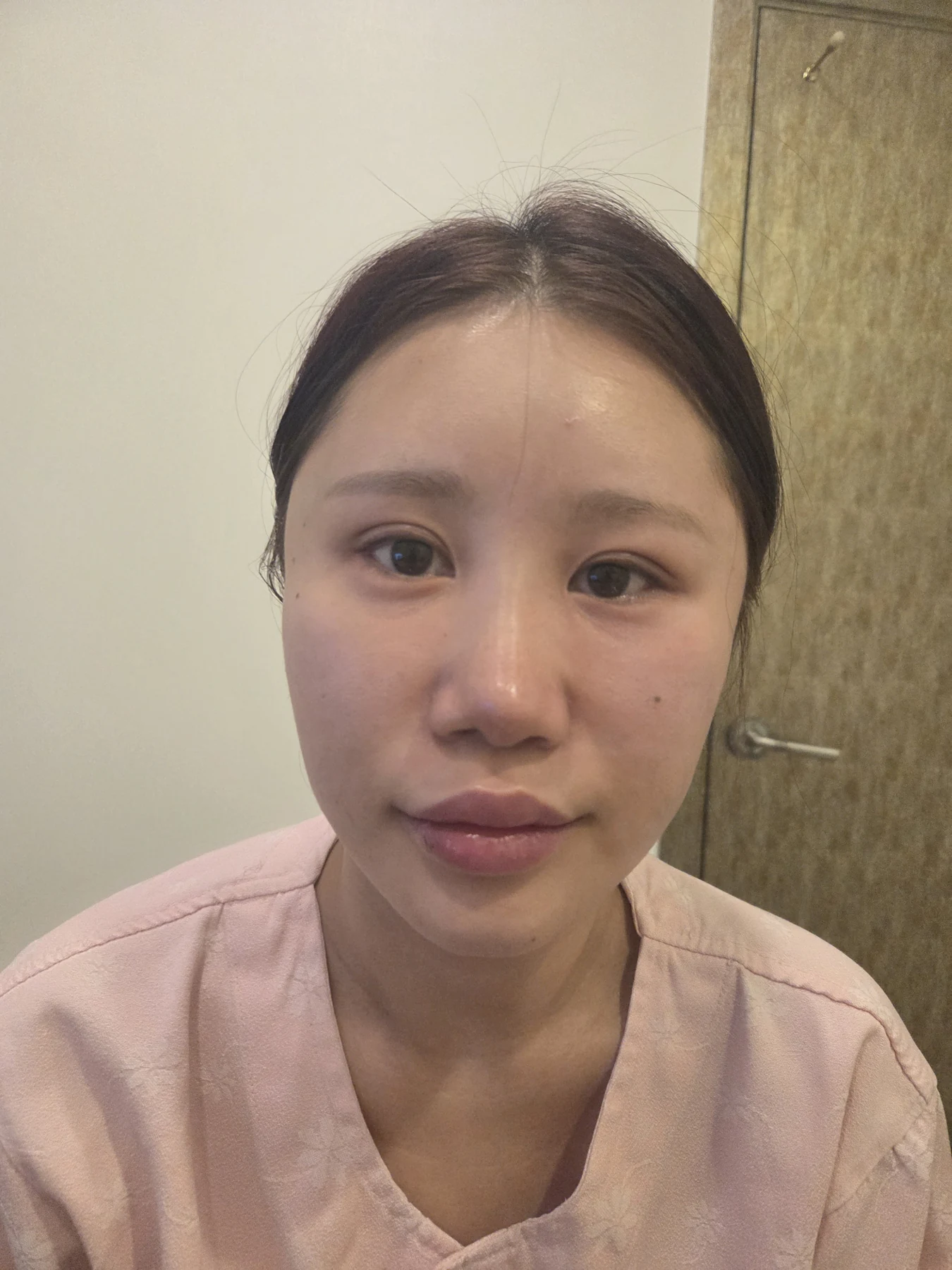Revision lateral canthoplasty after previous eye-corner surgery: one month · Case 093 at Answer Plastic Surgery. Front view — before, revision lateral canthoplasty after previous eye-corner surgery at Answer Plastic Surgery (case 093).