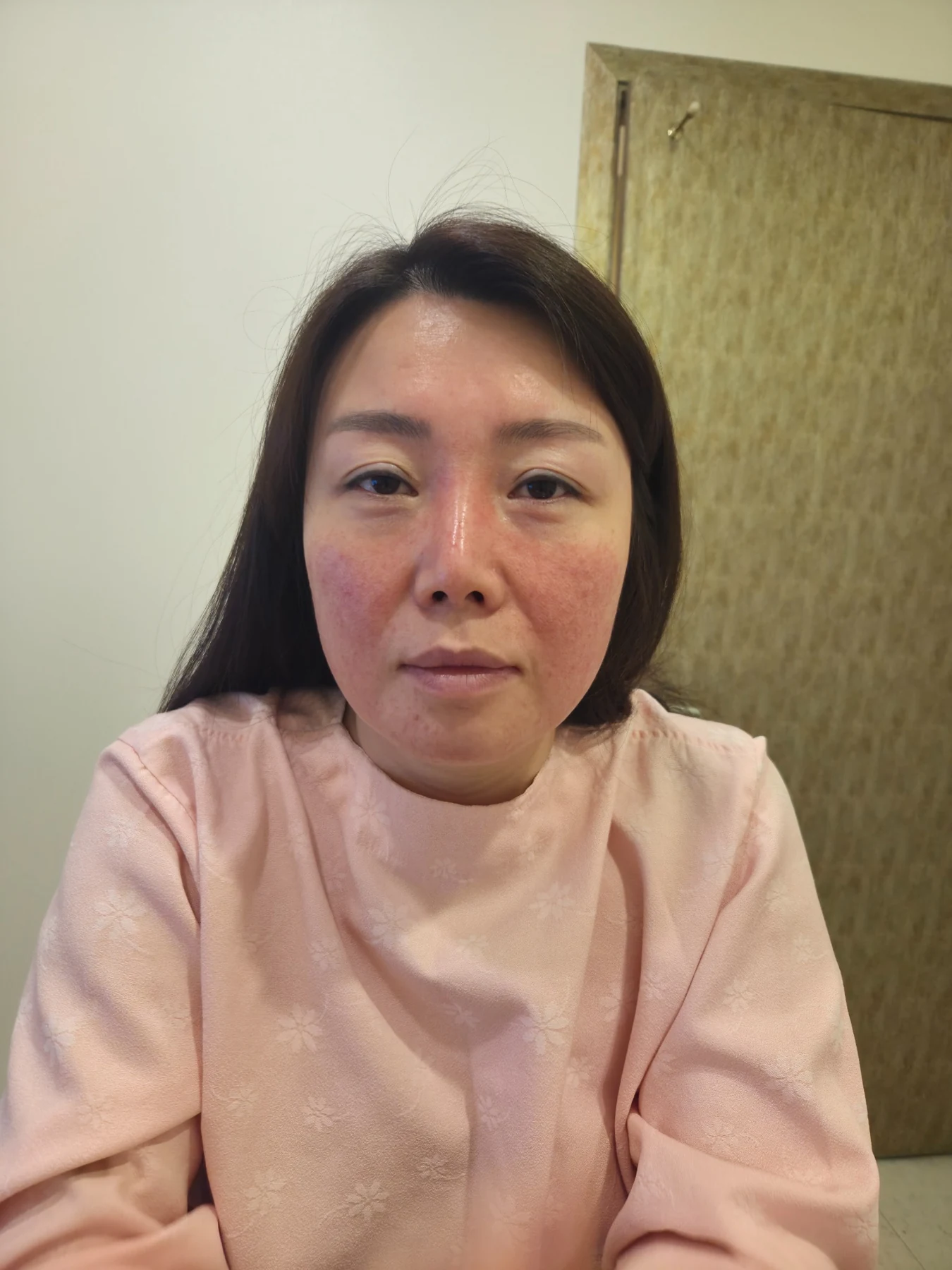 Revision rhinoplasty: recovery through three months · Case 094 at Answer Plastic Surgery. Front view — before, revision rhinoplasty at Answer Plastic Surgery, Seoul (case 094).