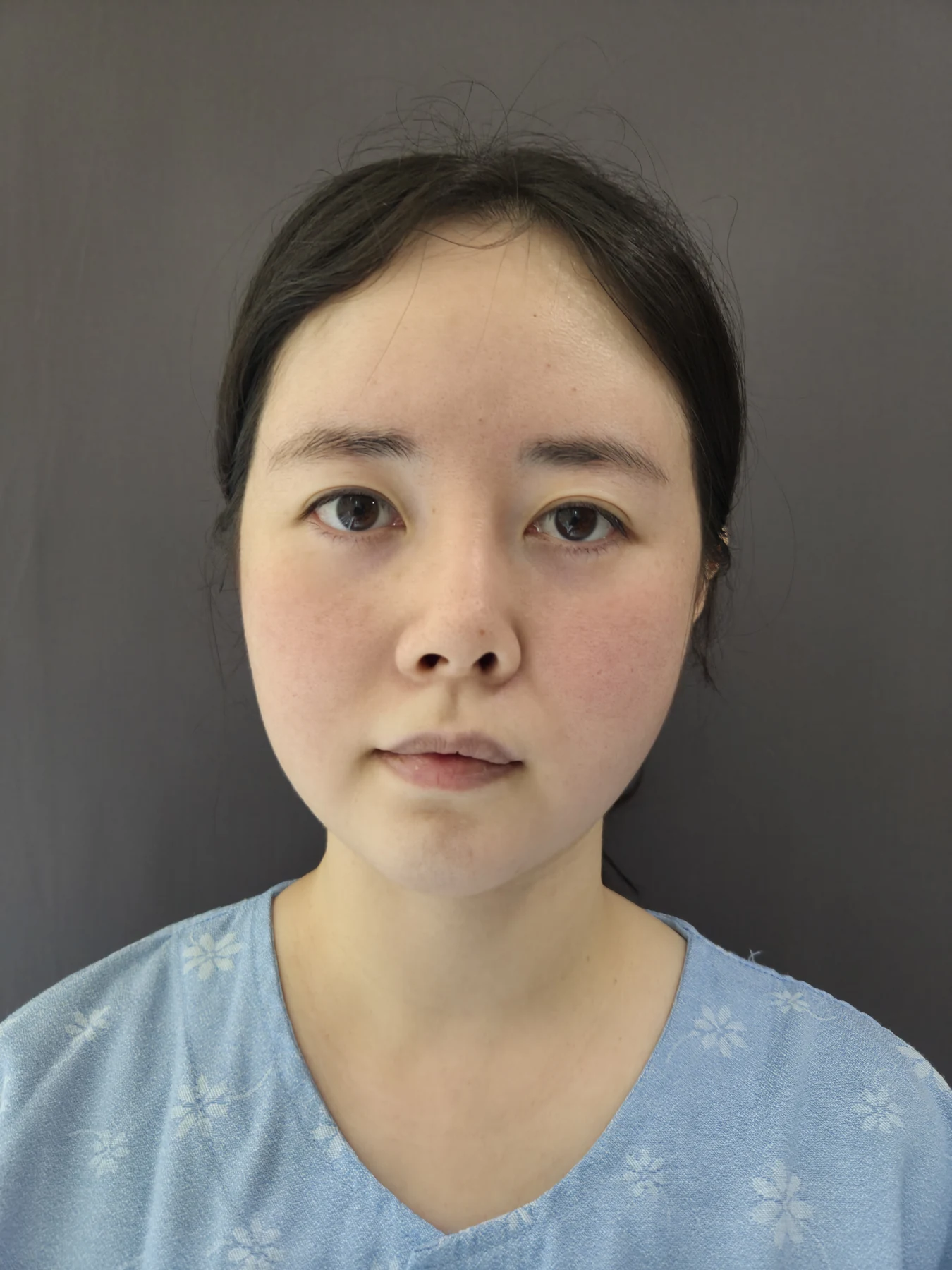 Rib-cartilage revision for a shortened, upturned nose: six months · Case 095 at Answer Plastic Surgery. Front view — before, rib-cartilage revision rhinoplasty at Answer Plastic Surgery, Seoul (case 095).