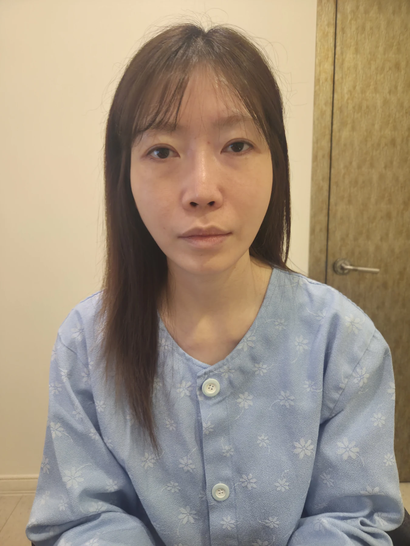 Revision rhinoplasty after an earlier ear-cartilage operation: six months · Case 096 at Answer Plastic Surgery. Front view — before, revision rhinoplasty at Answer Plastic Surgery, Seoul (case 096).
