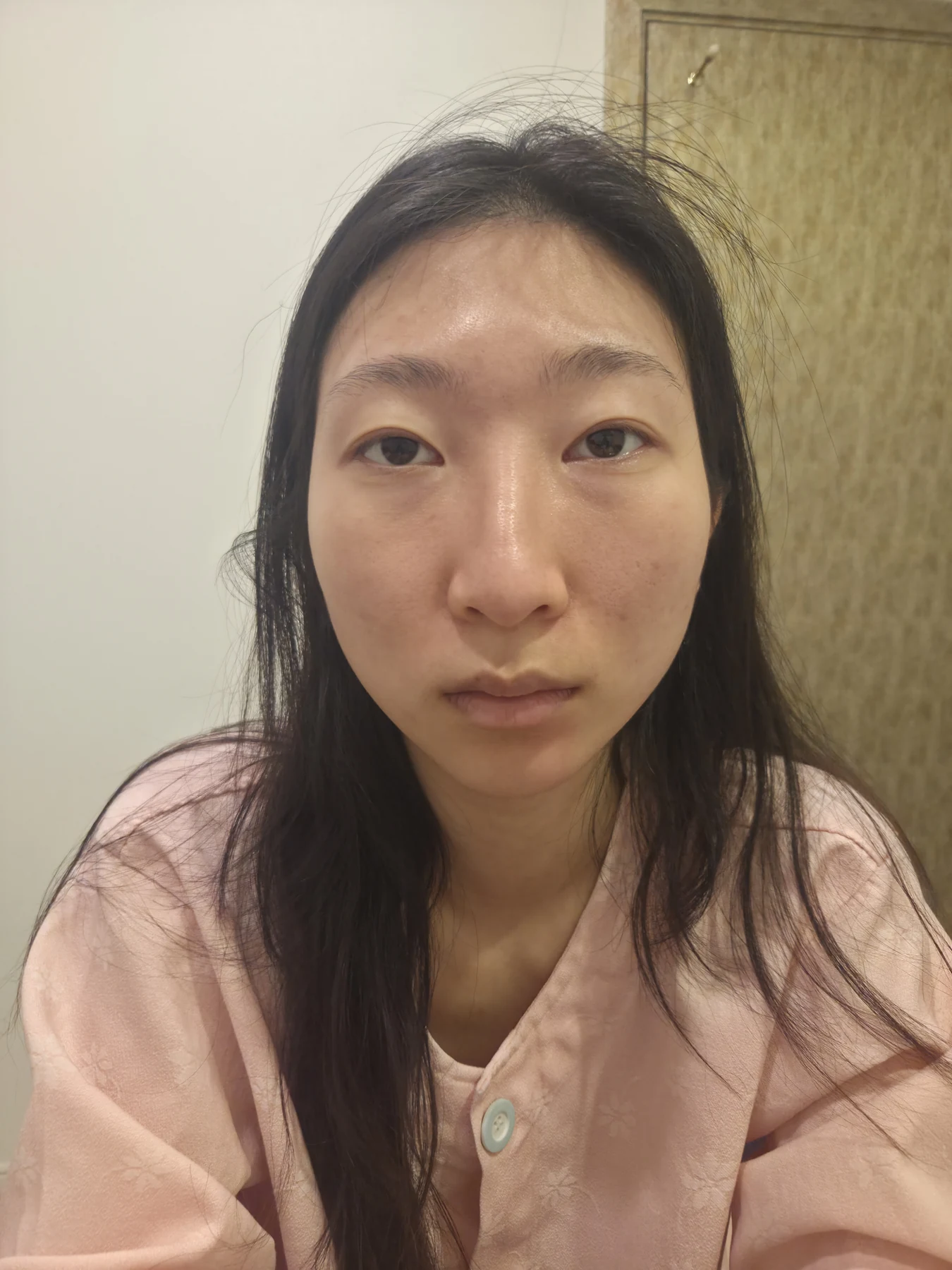 Nose surgery: recovery through three months · Case 097 at Answer Plastic Surgery. Front view — before, nose surgery at Answer Plastic Surgery, Seoul (case 097).