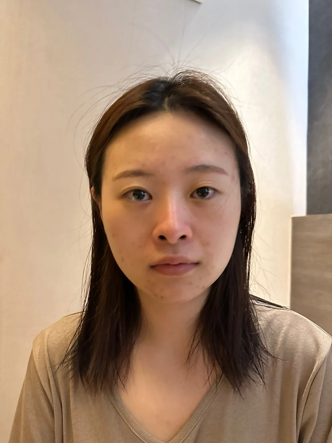 Revision rhinoplasty: the first month of recovery · Case 021 at Answer Plastic Surgery. Front view of the nose — before at Answer Plastic Surgery.