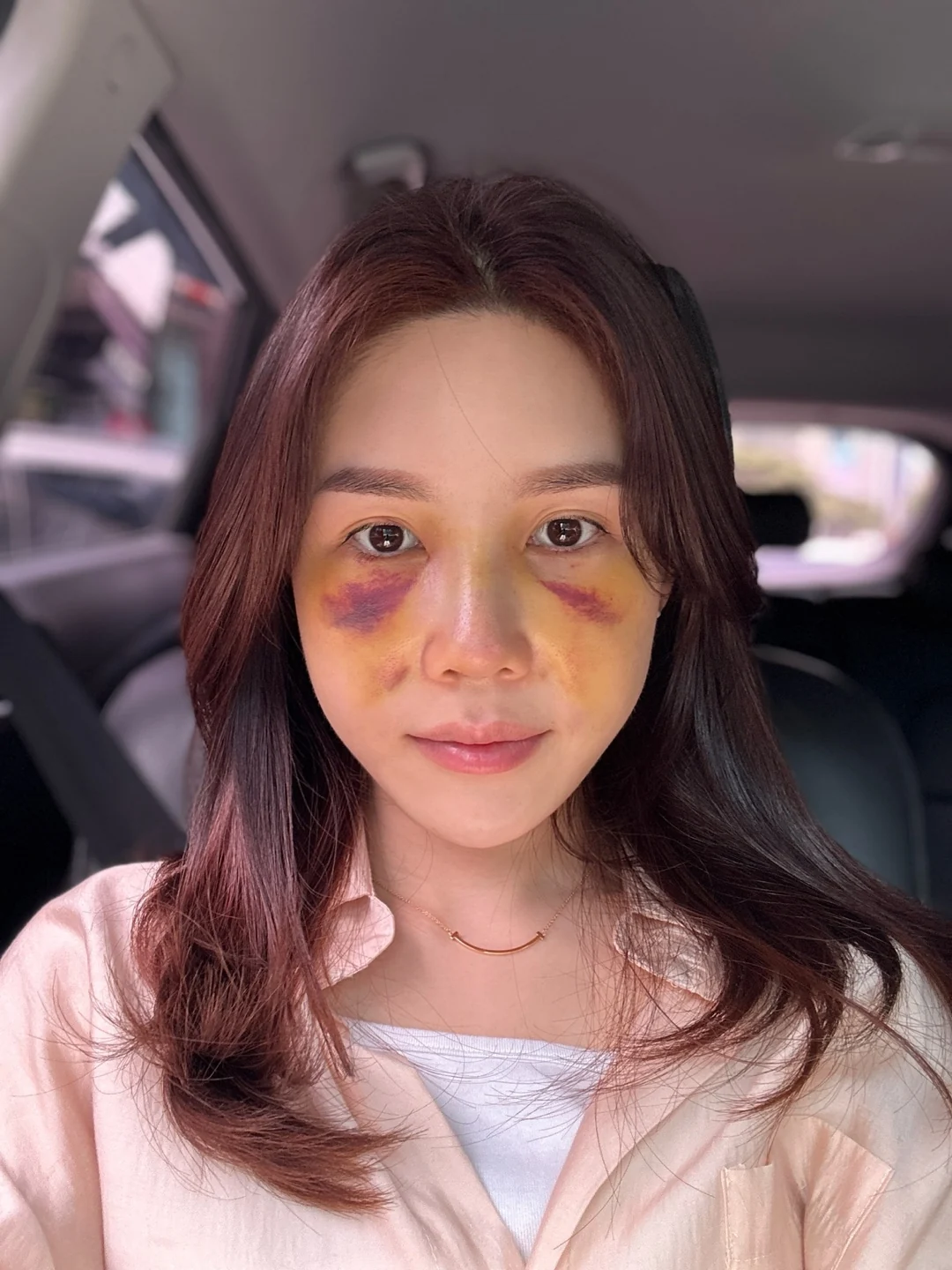 Rib-cartilage rhinoplasty: recovery through six months · Case 022 at Answer Plastic Surgery. Front view with visible postoperative bruising — 1 week at Answer Plastic Surgery.