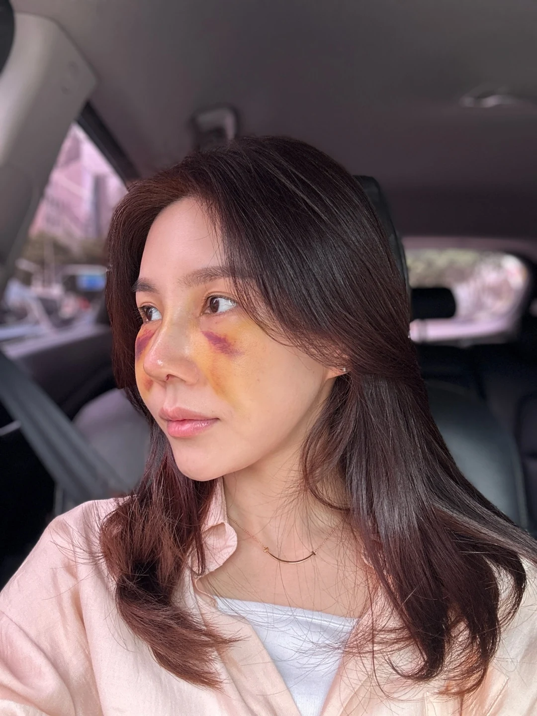 Rib-cartilage rhinoplasty: recovery through six months · Case 022 at Answer Plastic Surgery. Oblique view during early rhinoplasty recovery — 1 week at Answer Plastic Surgery.